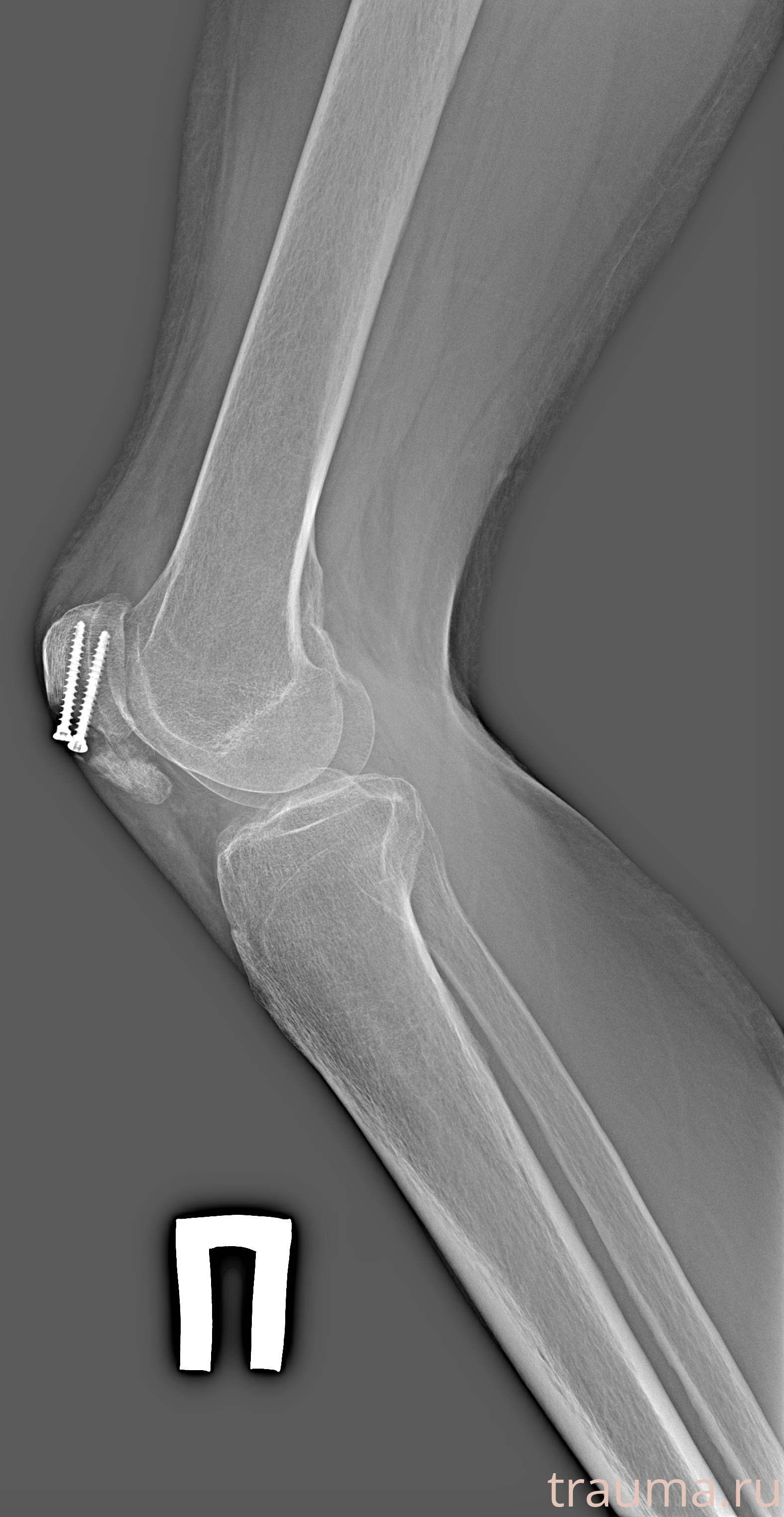 Рентген на дому: по вашему адресу приезжает врач-рентгенолог, травматолог-ортопед с мобильным рентгеновским аппаратом, проводит диагностику травмы или заболевания, делает необходимые рентгенограммы, дает рекомендации по дальнейшему лечению. Получить качественные снимки в домашних условиях возможно благодаря уникальной методике, разработанной МосРентген Центром для института  Склифосовского