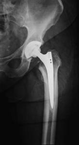 Скелетное вытяжение против наружной аппаратной фиксации в качестве средства первичной стабилизации перелома диафиза бедренной кости у пациентов с тяжелой травмой