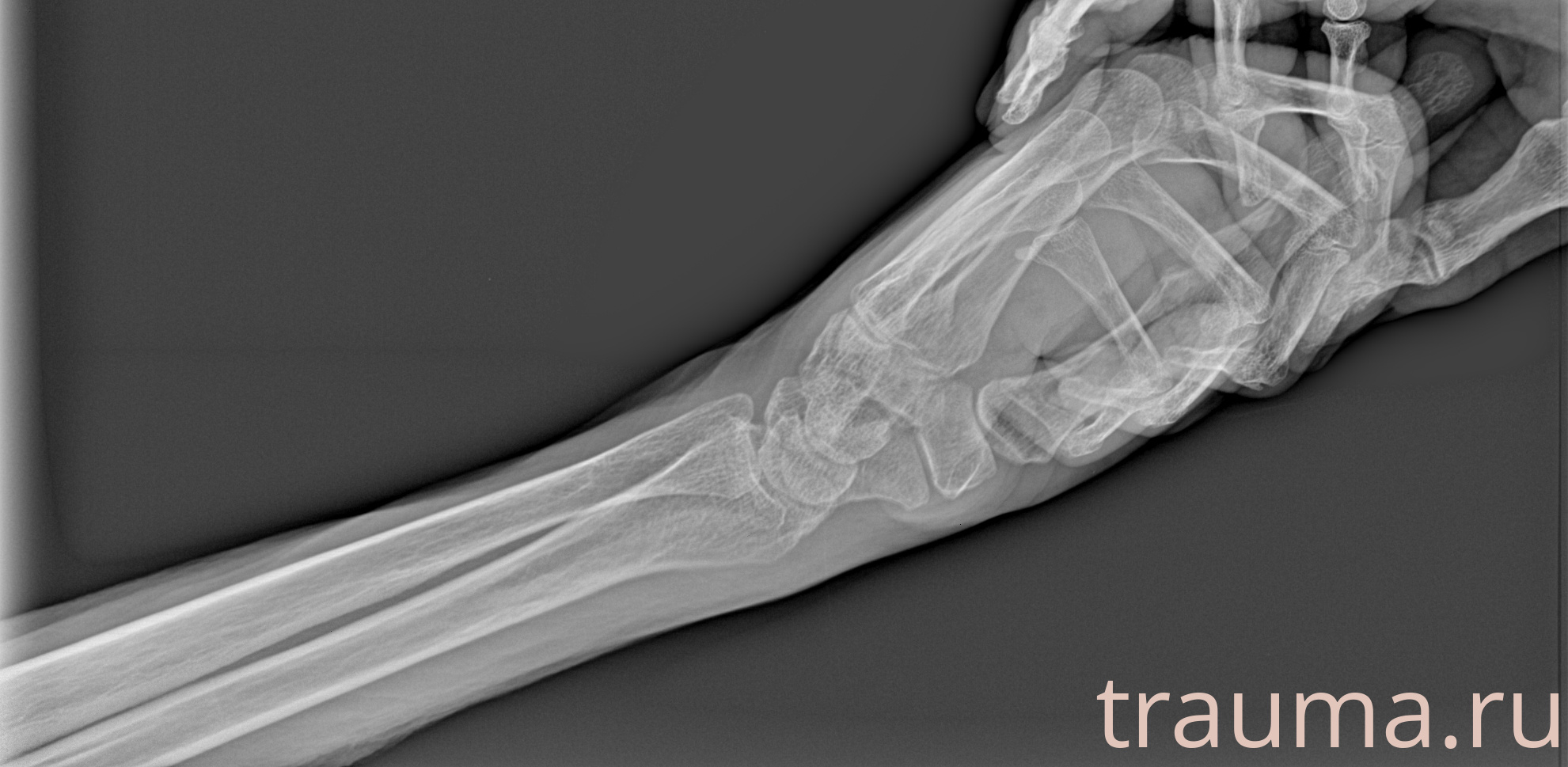 Рентген на дому: по вашему адресу приезжает врач-рентгенолог, травматолог-ортопед с мобильным рентгеновским аппаратом, проводит диагностику травмы или заболевания, делает необходимые рентгенограммы, дает рекомендации по дальнейшему лечению. Получить качественные снимки в домашних условиях возможно благодаря уникальной методике, разработанной МосРентген Центром для института  Склифосовского