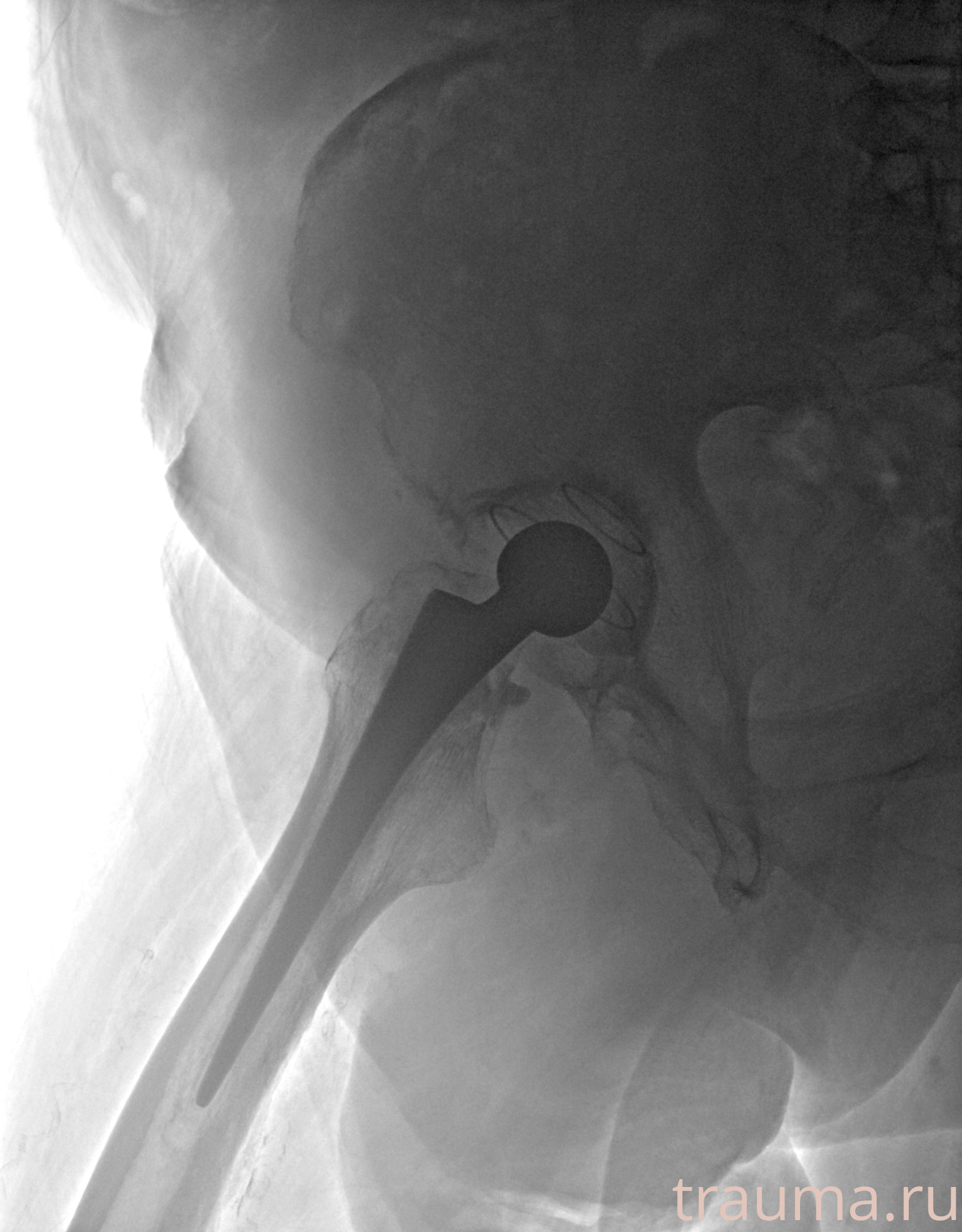 Рентген на дому: по вашему адресу приезжает врач-рентгенолог, травматолог-ортопед с мобильным рентгеновским аппаратом, проводит диагностику травмы или заболевания, делает необходимые рентгенограммы, дает рекомендации по дальнейшему лечению. Получить качественные снимки в домашних условиях возможно благодаря уникальной методике, разработанной МосРентген Центром для института  Склифосовского