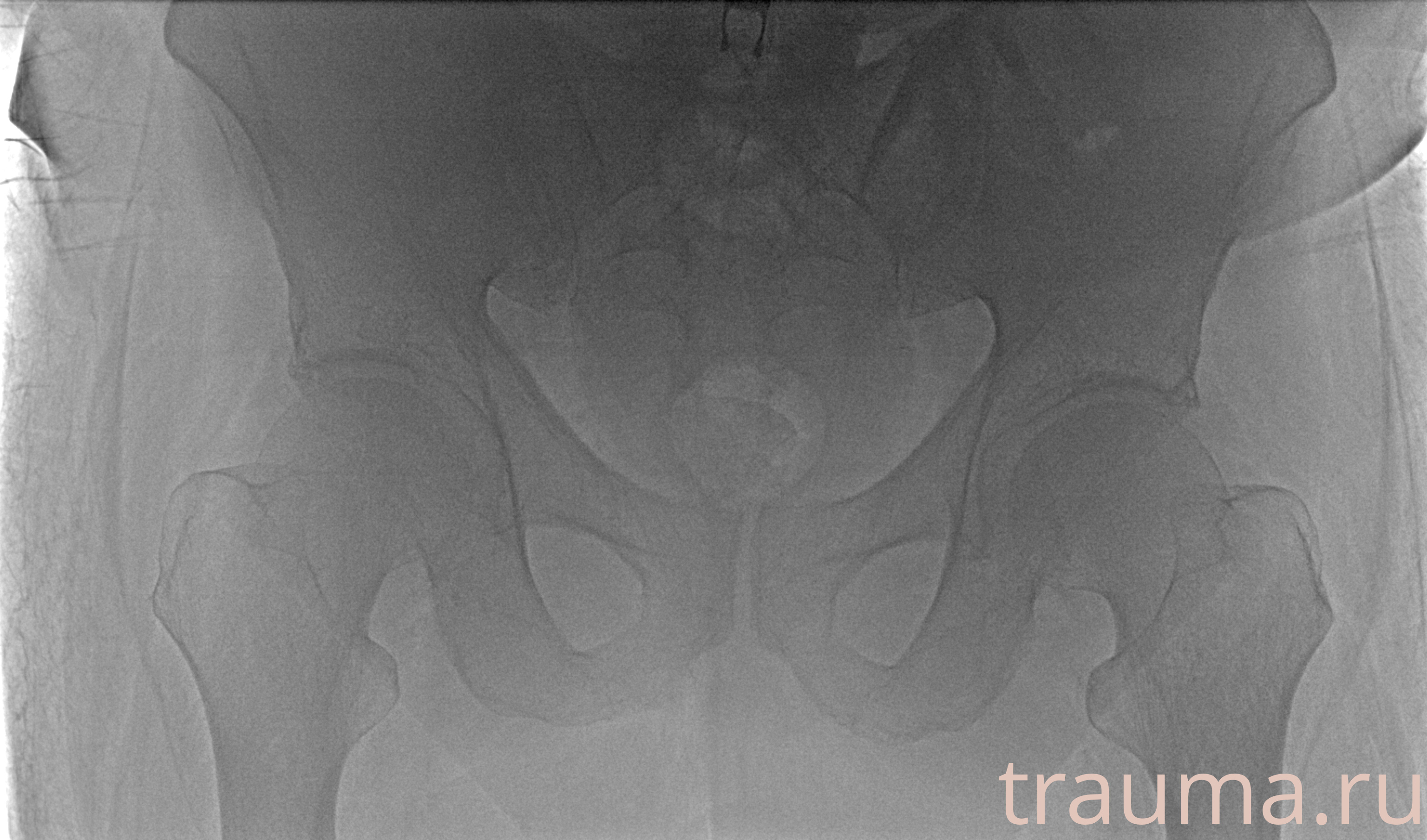 Рентген на дому: по вашему адресу приезжает врач-рентгенолог, травматолог-ортопед с мобильным рентгеновским аппаратом, проводит диагностику травмы или заболевания, делает необходимые рентгенограммы, дает рекомендации по дальнейшему лечению. Получить качественные снимки в домашних условиях возможно благодаря уникальной методике, разработанной МосРентген Центром для института  Склифосовского