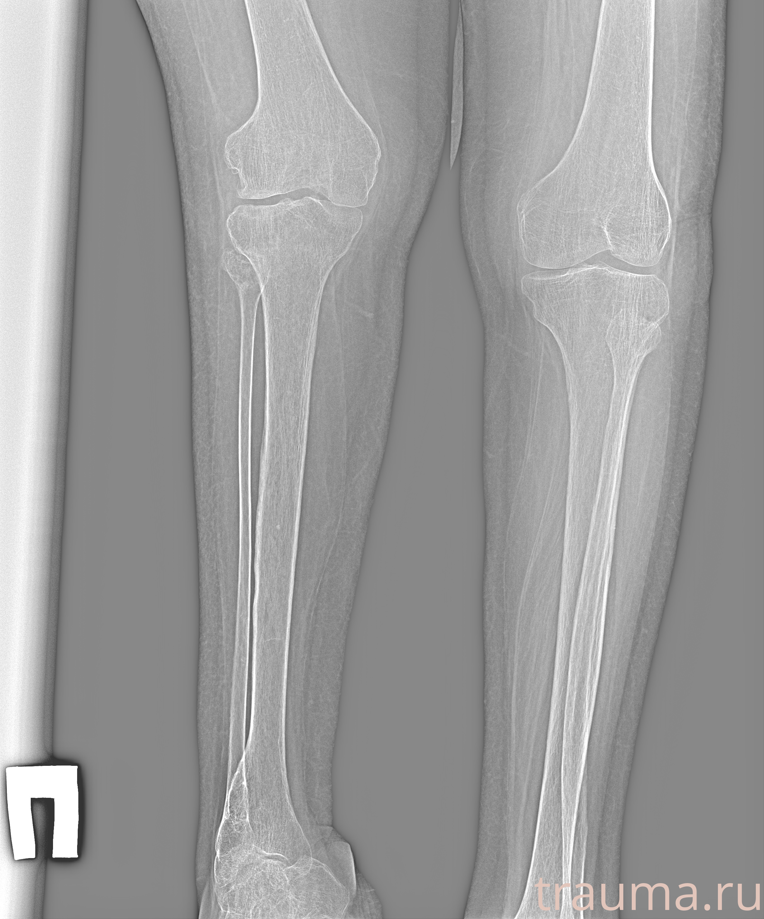 Рентген на дому: по вашему адресу приезжает врач-рентгенолог, травматолог-ортопед с мобильным рентгеновским аппаратом, проводит диагностику травмы или заболевания, делает необходимые рентгенограммы, дает рекомендации по дальнейшему лечению. Получить качественные снимки в домашних условиях возможно благодаря уникальной методике, разработанной МосРентген Центром для института  Склифосовского