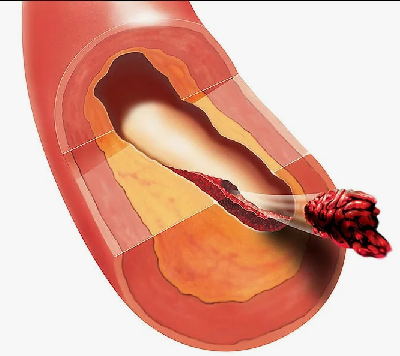 Есть ли шанс, когда уже не можешь говорить, а половина тела - парализована? 