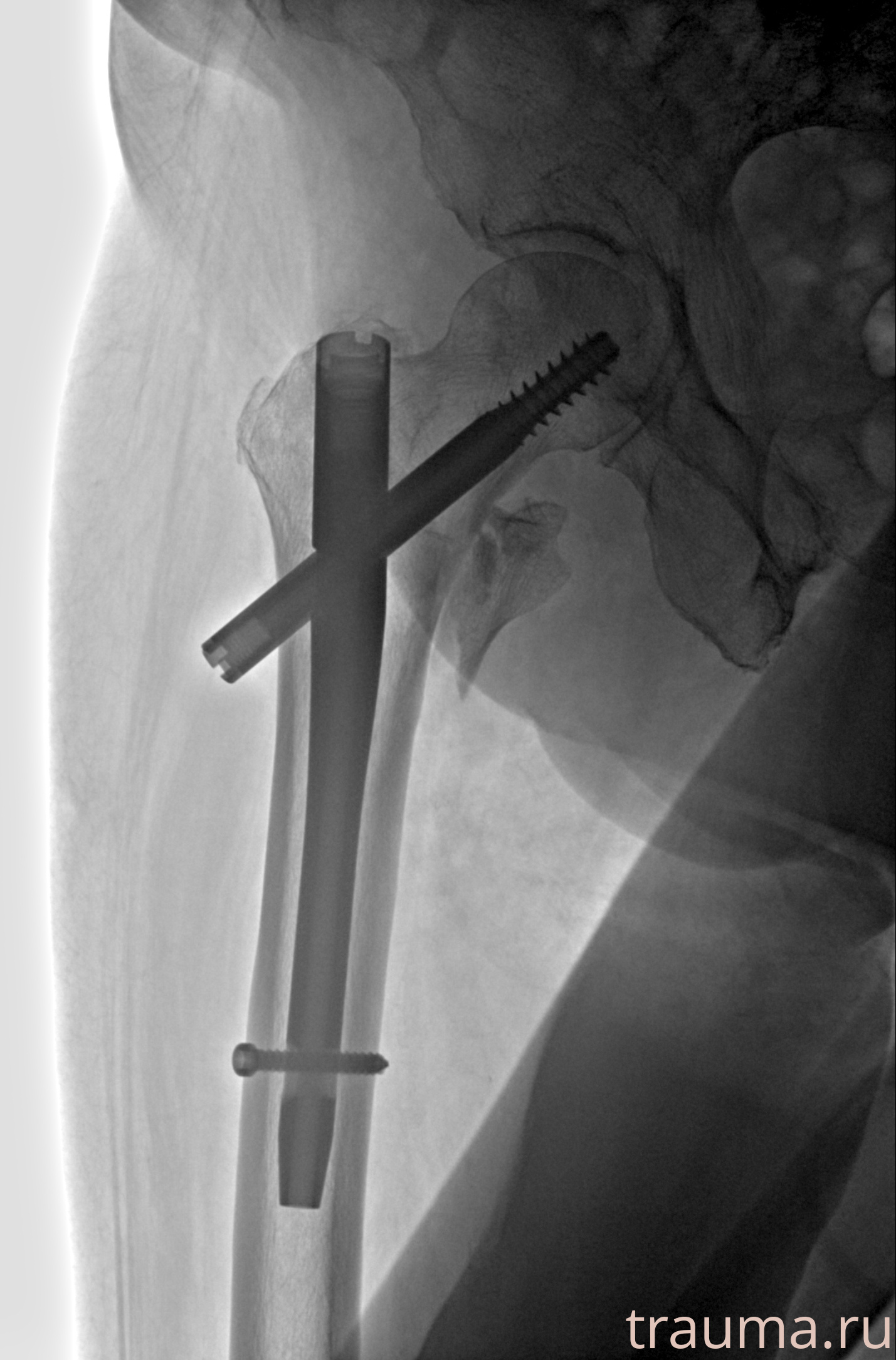 Рентген на дому: по вашему адресу приезжает врач-рентгенолог, травматолог-ортопед с мобильным рентгеновским аппаратом, проводит диагностику травмы или заболевания, делает необходимые рентгенограммы, дает рекомендации по дальнейшему лечению. Получить качественные снимки в домашних условиях возможно благодаря уникальной методике, разработанной МосРентген Центром для института  Склифосовского