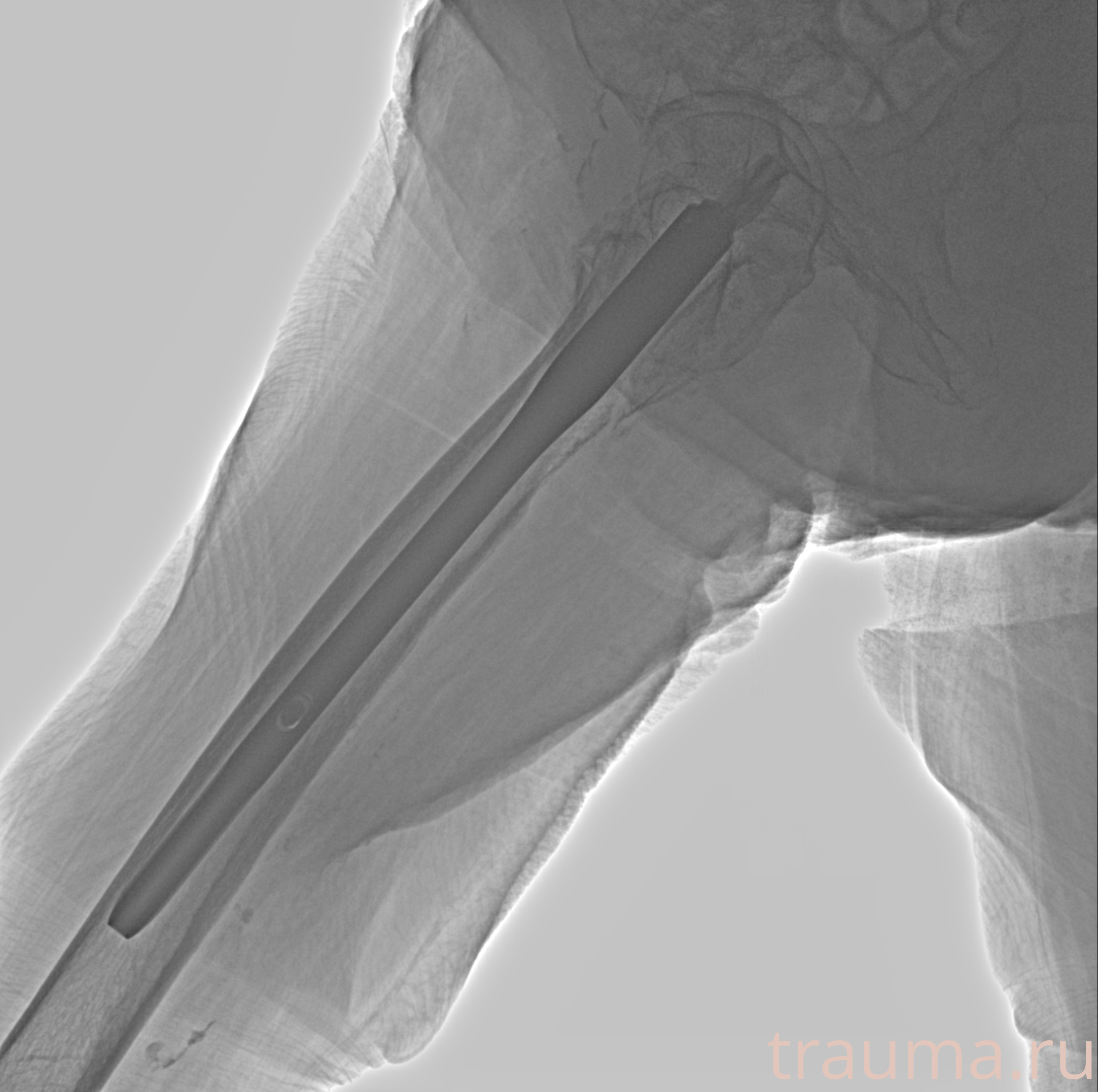 Рентген на дому: по вашему адресу приезжает врач-рентгенолог, травматолог-ортопед с мобильным рентгеновским аппаратом, проводит диагностику травмы или заболевания, делает необходимые рентгенограммы, дает рекомендации по дальнейшему лечению. Получить качественные снимки в домашних условиях возможно благодаря уникальной методике, разработанной МосРентген Центром для института  Склифосовского