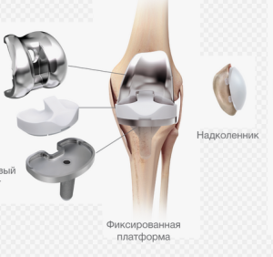 Влияние принципа персонализированного выравнивания на положение компонентов эндопротеза при тотальном эндопротезировании коленного сустава