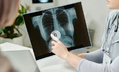 ИИ научился читать снимки легких лучше рентгенологов