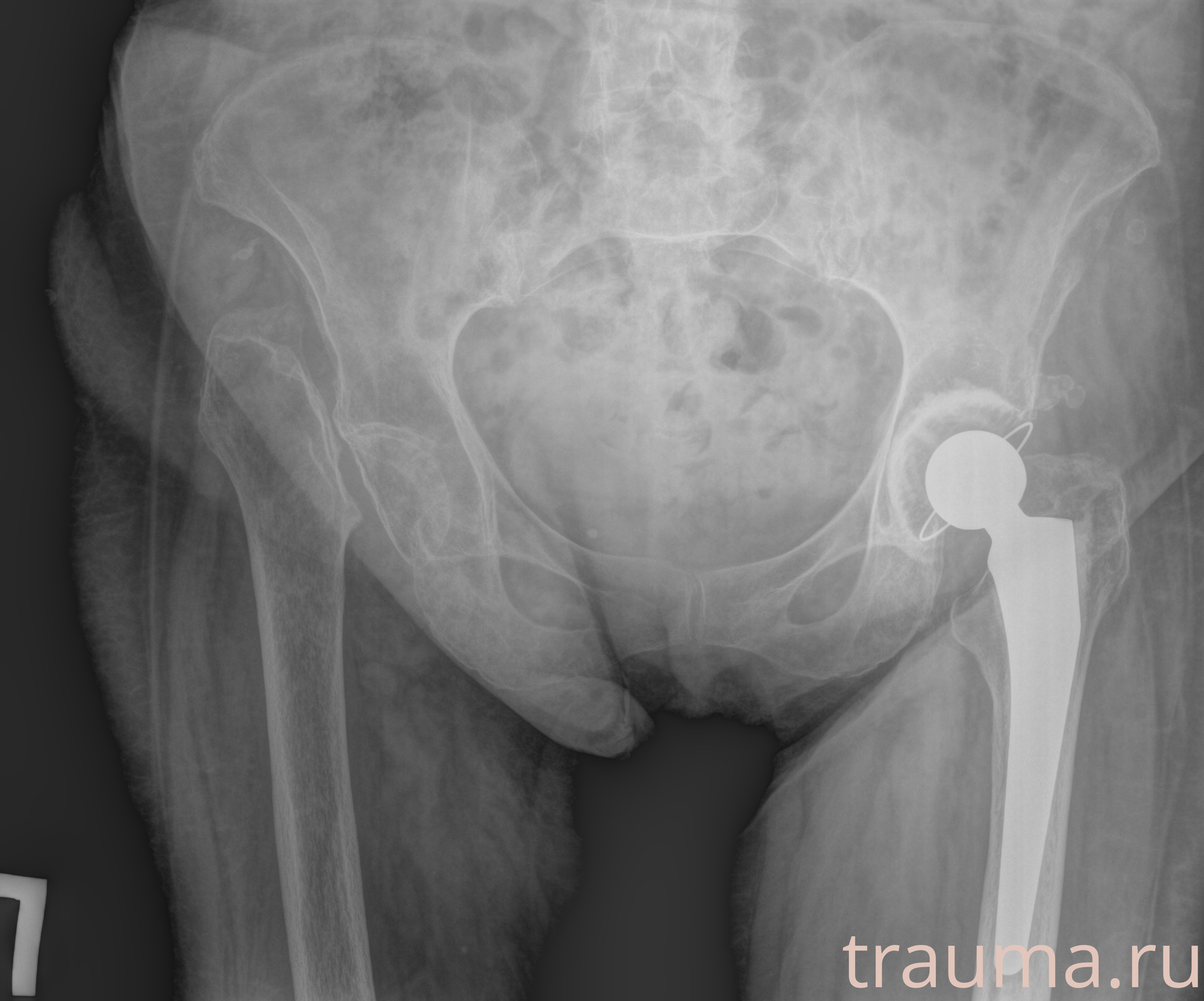 Рентген на дому: по вашему адресу приезжает врач-рентгенолог, травматолог-ортопед с мобильным рентгеновским аппаратом, проводит диагностику травмы или заболевания, делает необходимые рентгенограммы, дает рекомендации по дальнейшему лечению. Получить качественные снимки в домашних условиях возможно благодаря уникальной методике, разработанной МосРентген Центром для института  Склифосовского