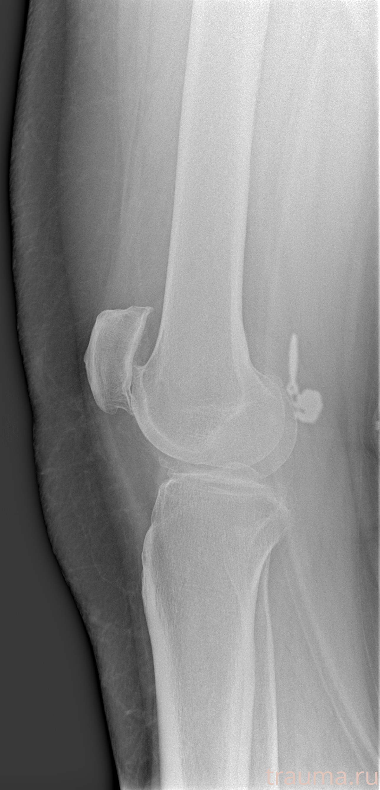 Рентген на дому: по вашему адресу приезжает врач-рентгенолог, травматолог-ортопед с мобильным рентгеновским аппаратом, проводит диагностику травмы или заболевания, делает необходимые рентгенограммы, дает рекомендации по дальнейшему лечению. Получить качественные снимки в домашних условиях возможно благодаря уникальной методике, разработанной МосРентген Центром для института  Склифосовского