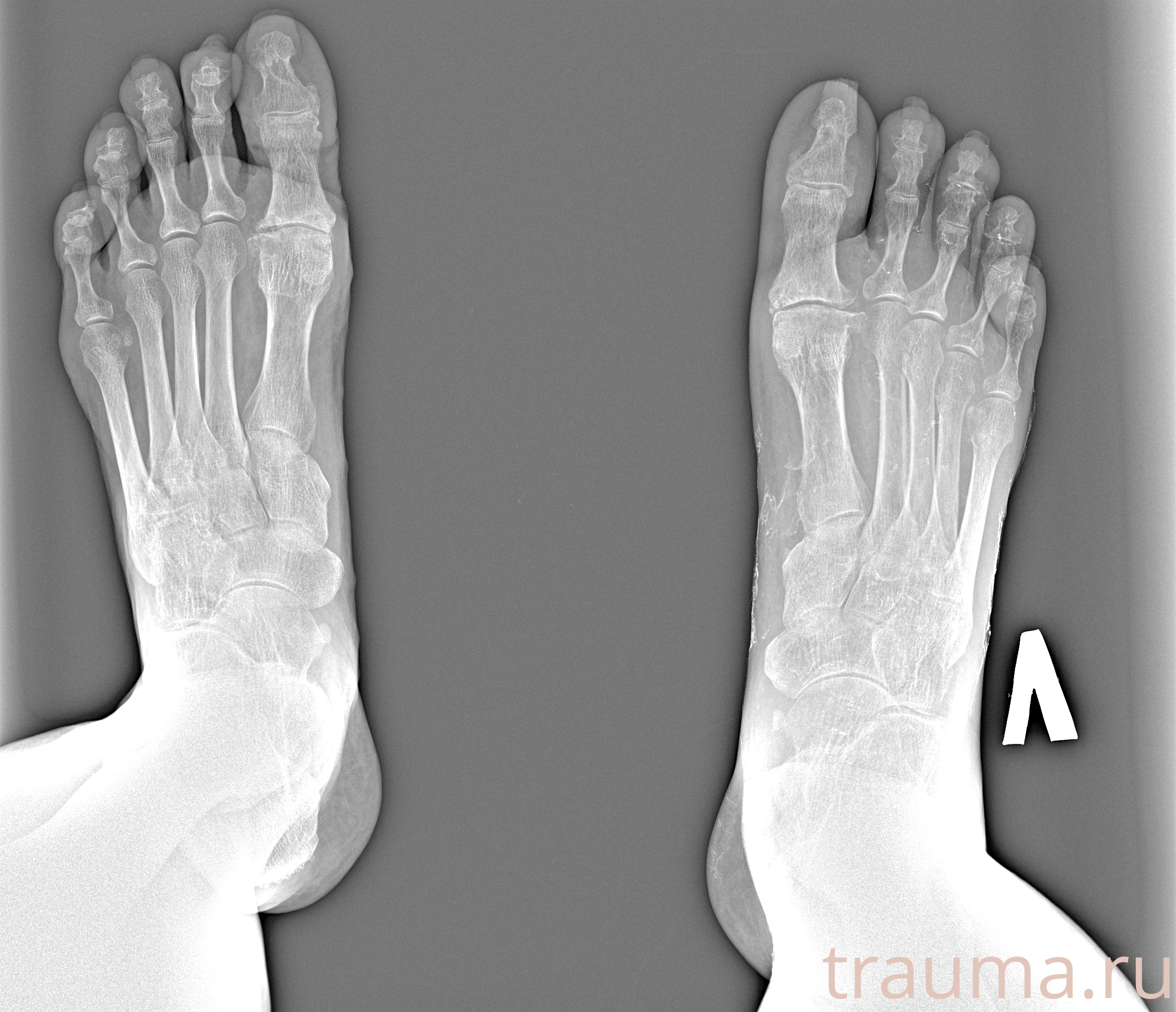 Рентген на дому: по вашему адресу приезжает врач-рентгенолог, травматолог-ортопед с мобильным рентгеновским аппаратом, проводит диагностику травмы или заболевания, делает необходимые рентгенограммы, дает рекомендации по дальнейшему лечению. Получить качественные снимки в домашних условиях возможно благодаря уникальной методике, разработанной МосРентген Центром для института  Склифосовского