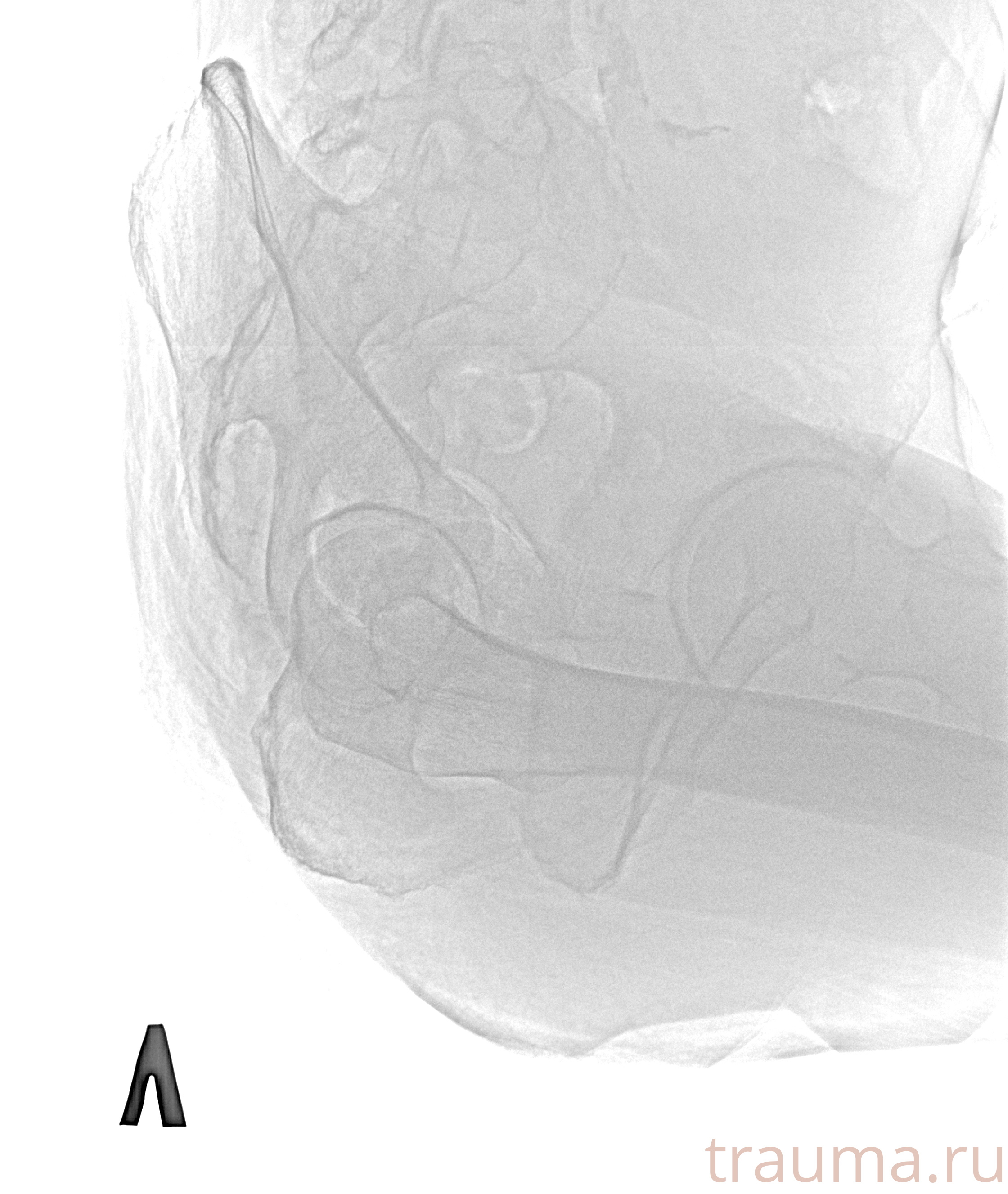 Рентген на дому: по вашему адресу приезжает врач-рентгенолог, травматолог-ортопед с мобильным рентгеновским аппаратом, проводит диагностику травмы или заболевания, делает необходимые рентгенограммы, дает рекомендации по дальнейшему лечению. Получить качественные снимки в домашних условиях возможно благодаря уникальной методике, разработанной МосРентген Центром для института  Склифосовского