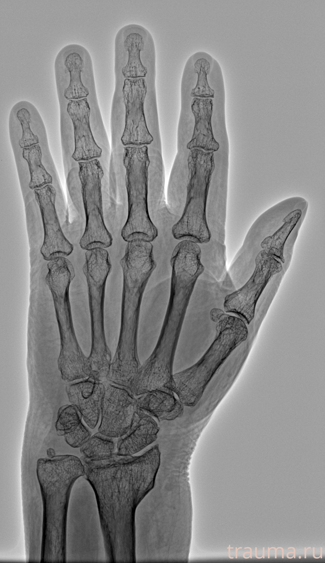 Рентген на дому: по вашему адресу приезжает врач-рентгенолог, травматолог-ортопед с мобильным рентгеновским аппаратом, проводит диагностику травмы или заболевания, делает необходимые рентгенограммы, дает рекомендации по дальнейшему лечению. Получить качественные снимки в домашних условиях возможно благодаря уникальной методике, разработанной МосРентген Центром для института  Склифосовского