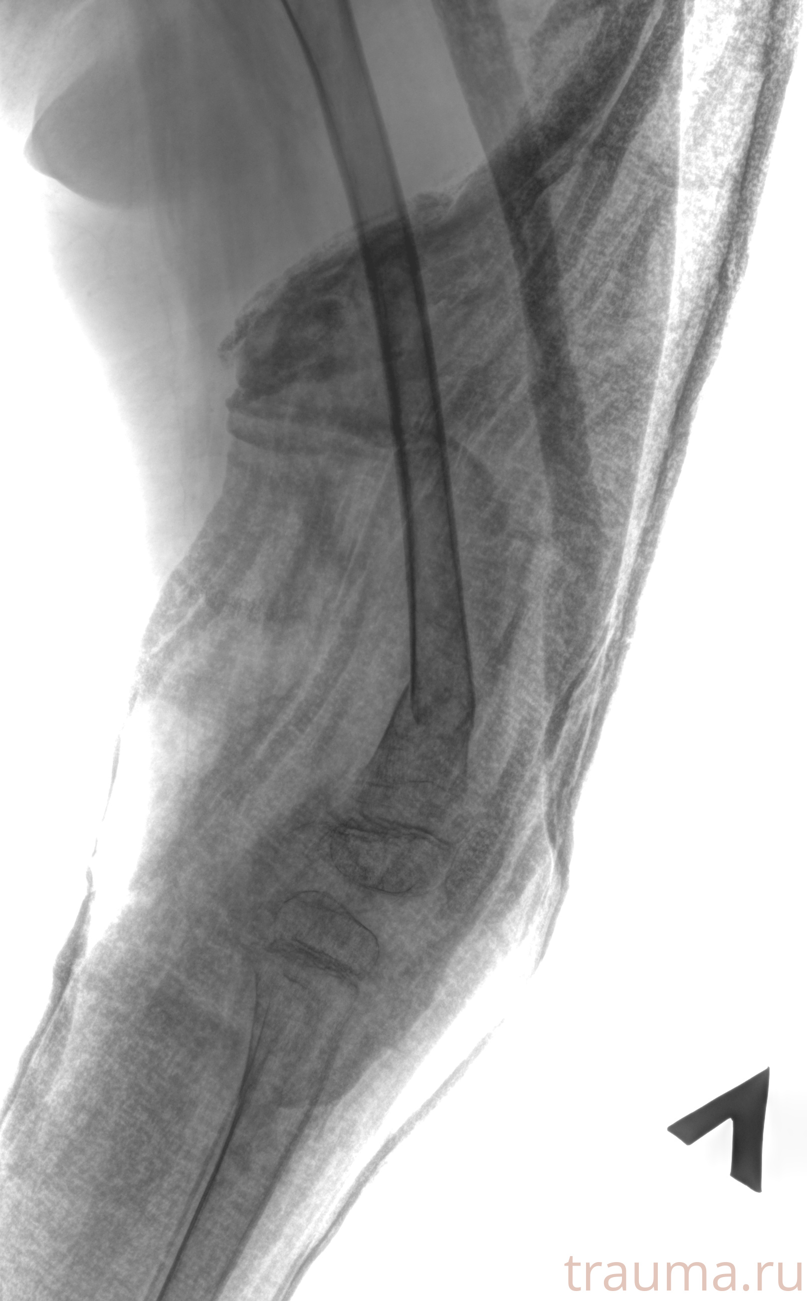 Рентген на дому: по вашему адресу приезжает врач-рентгенолог, травматолог-ортопед с мобильным рентгеновским аппаратом, проводит диагностику травмы или заболевания, делает необходимые рентгенограммы, дает рекомендации по дальнейшему лечению. Получить качественные снимки в домашних условиях возможно благодаря уникальной методике, разработанной МосРентген Центром для института  Склифосовского