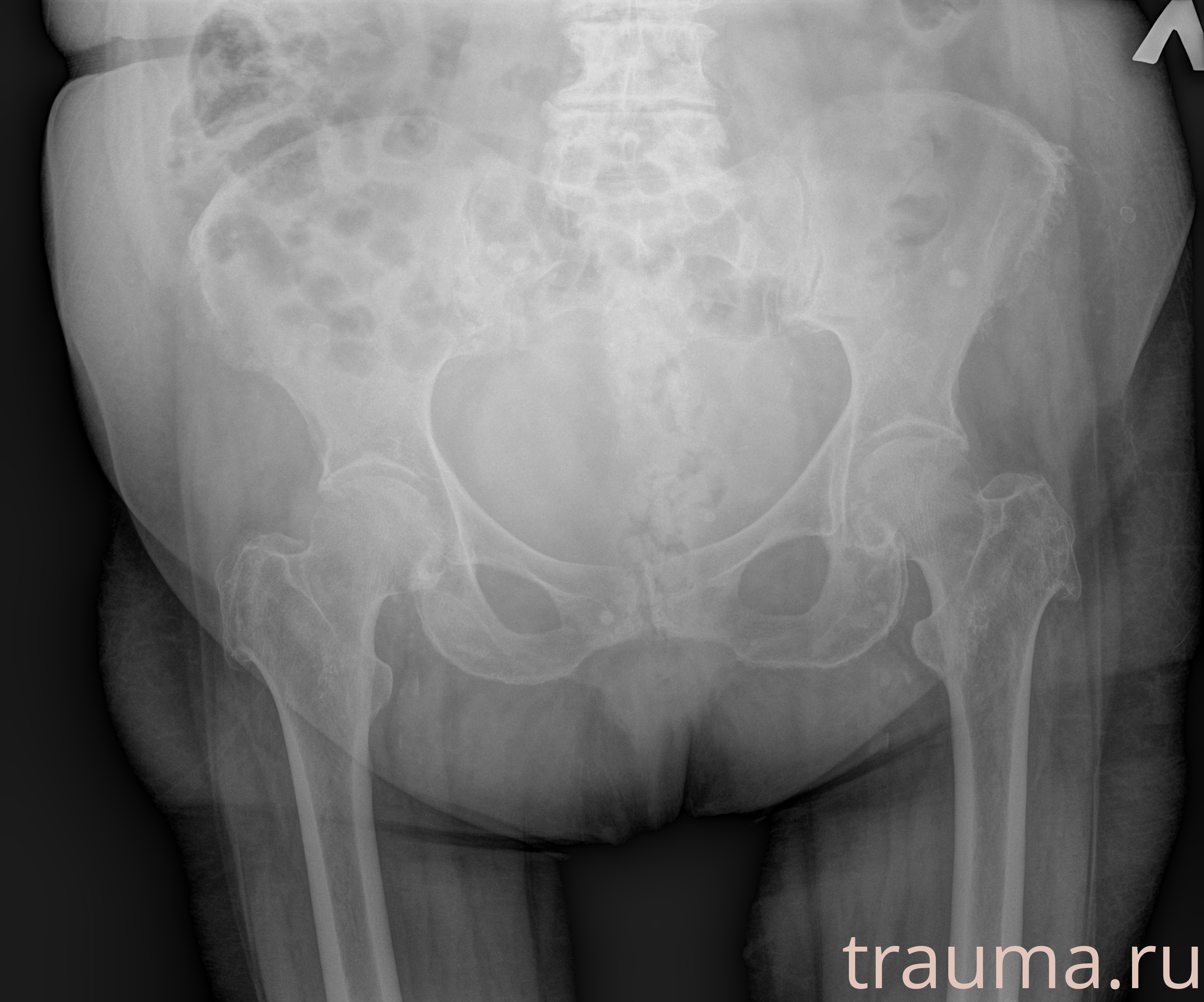 Рентген на дому: по вашему адресу приезжает врач-рентгенолог, травматолог-ортопед с мобильным рентгеновским аппаратом, проводит диагностику травмы или заболевания, делает необходимые рентгенограммы, дает рекомендации по дальнейшему лечению. Получить качественные снимки в домашних условиях возможно благодаря уникальной методике, разработанной МосРентген Центром для института  Склифосовского