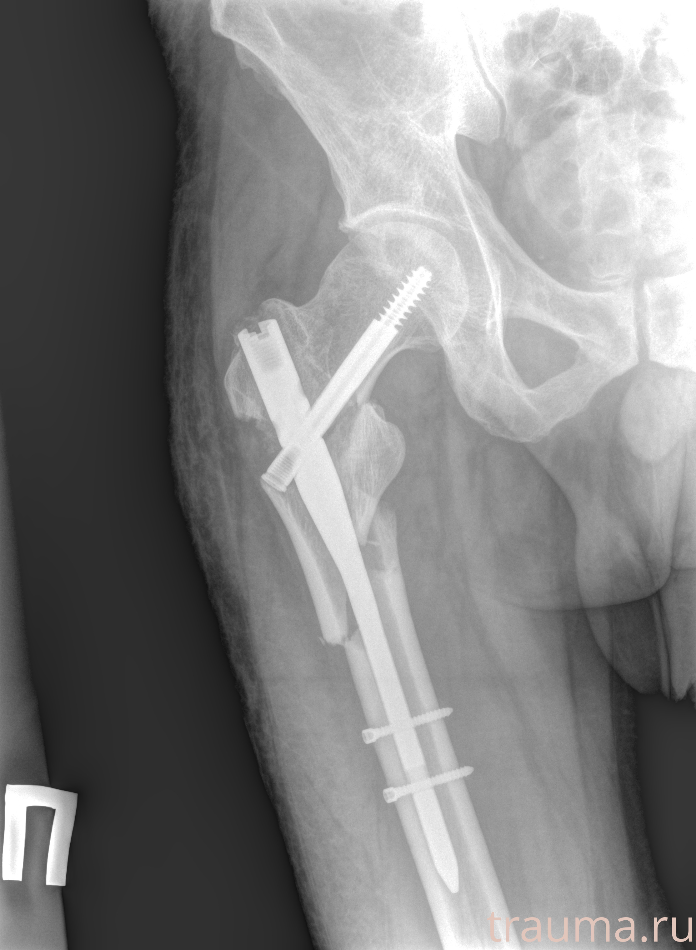Рентген на дому: по вашему адресу приезжает врач-рентгенолог, травматолог-ортопед с мобильным рентгеновским аппаратом, проводит диагностику травмы или заболевания, делает необходимые рентгенограммы, дает рекомендации по дальнейшему лечению. Получить качественные снимки в домашних условиях возможно благодаря уникальной методике, разработанной МосРентген Центром для института  Склифосовского