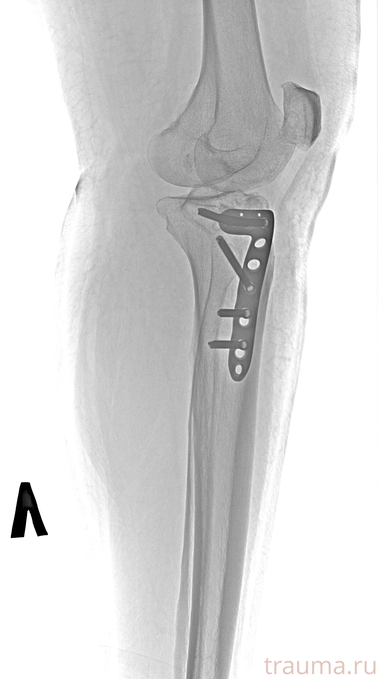 Рентген на дому: по вашему адресу приезжает врач-рентгенолог, травматолог-ортопед с мобильным рентгеновским аппаратом, проводит диагностику травмы или заболевания, делает необходимые рентгенограммы, дает рекомендации по дальнейшему лечению. Получить качественные снимки в домашних условиях возможно благодаря уникальной методике, разработанной МосРентген Центром для института  Склифосовского