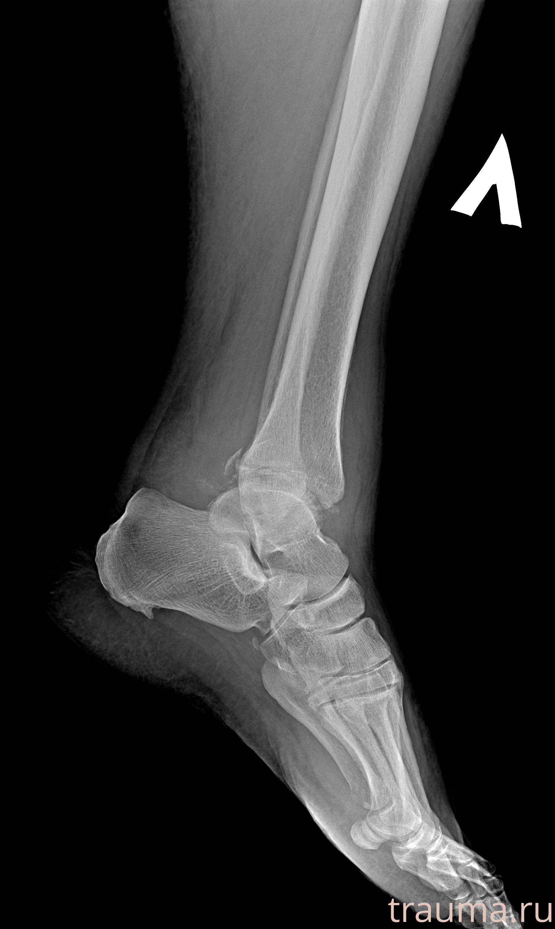 Рентген на дому: по вашему адресу приезжает врач-рентгенолог, травматолог-ортопед с мобильным рентгеновским аппаратом, проводит диагностику травмы или заболевания, делает необходимые рентгенограммы, дает рекомендации по дальнейшему лечению. Получить качественные снимки в домашних условиях возможно благодаря уникальной методике, разработанной МосРентген Центром для института  Склифосовского