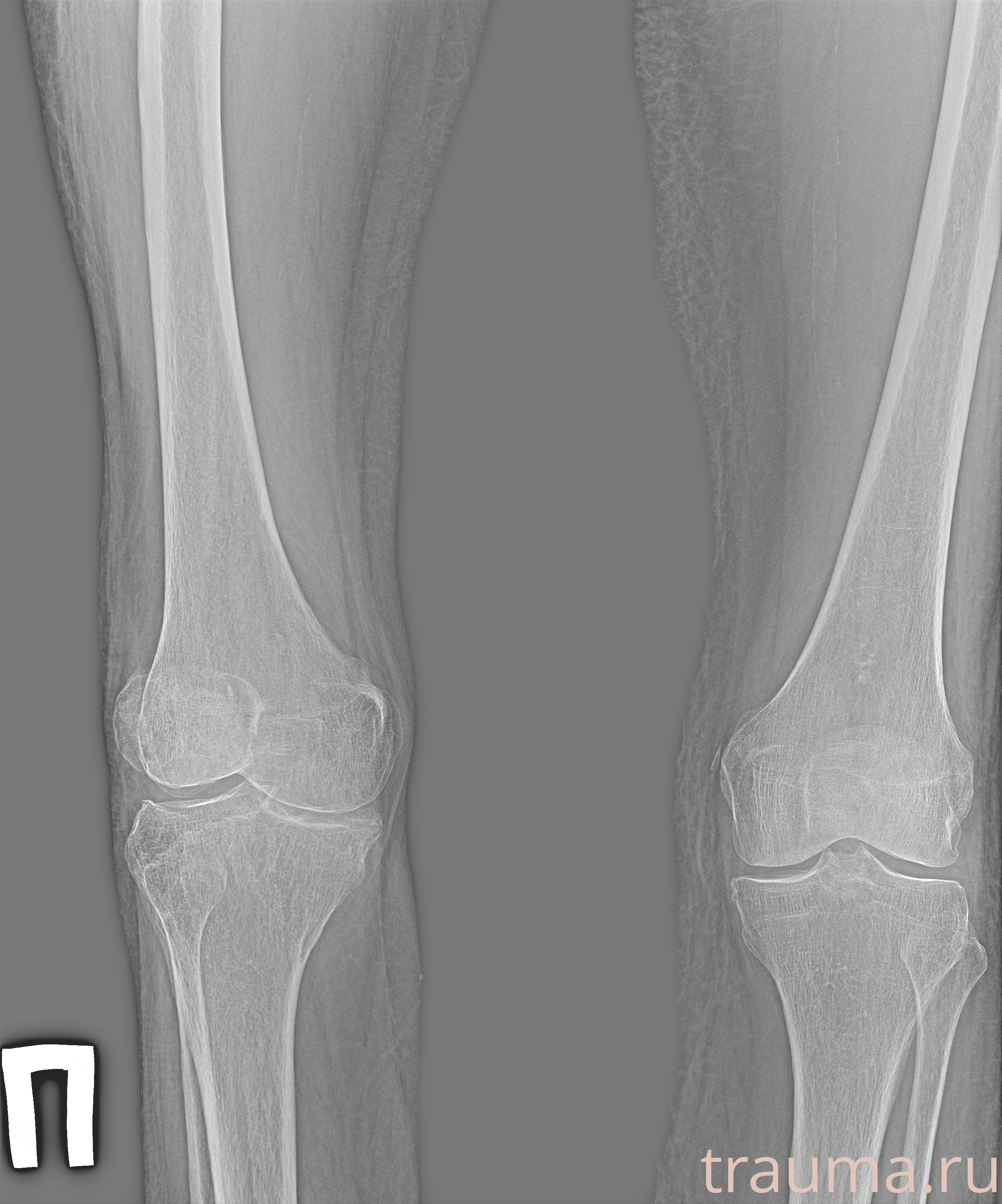 Рентген на дому: по вашему адресу приезжает врач-рентгенолог, травматолог-ортопед с мобильным рентгеновским аппаратом, проводит диагностику травмы или заболевания, делает необходимые рентгенограммы, дает рекомендации по дальнейшему лечению. Получить качественные снимки в домашних условиях возможно благодаря уникальной методике, разработанной МосРентген Центром для института  Склифосовского