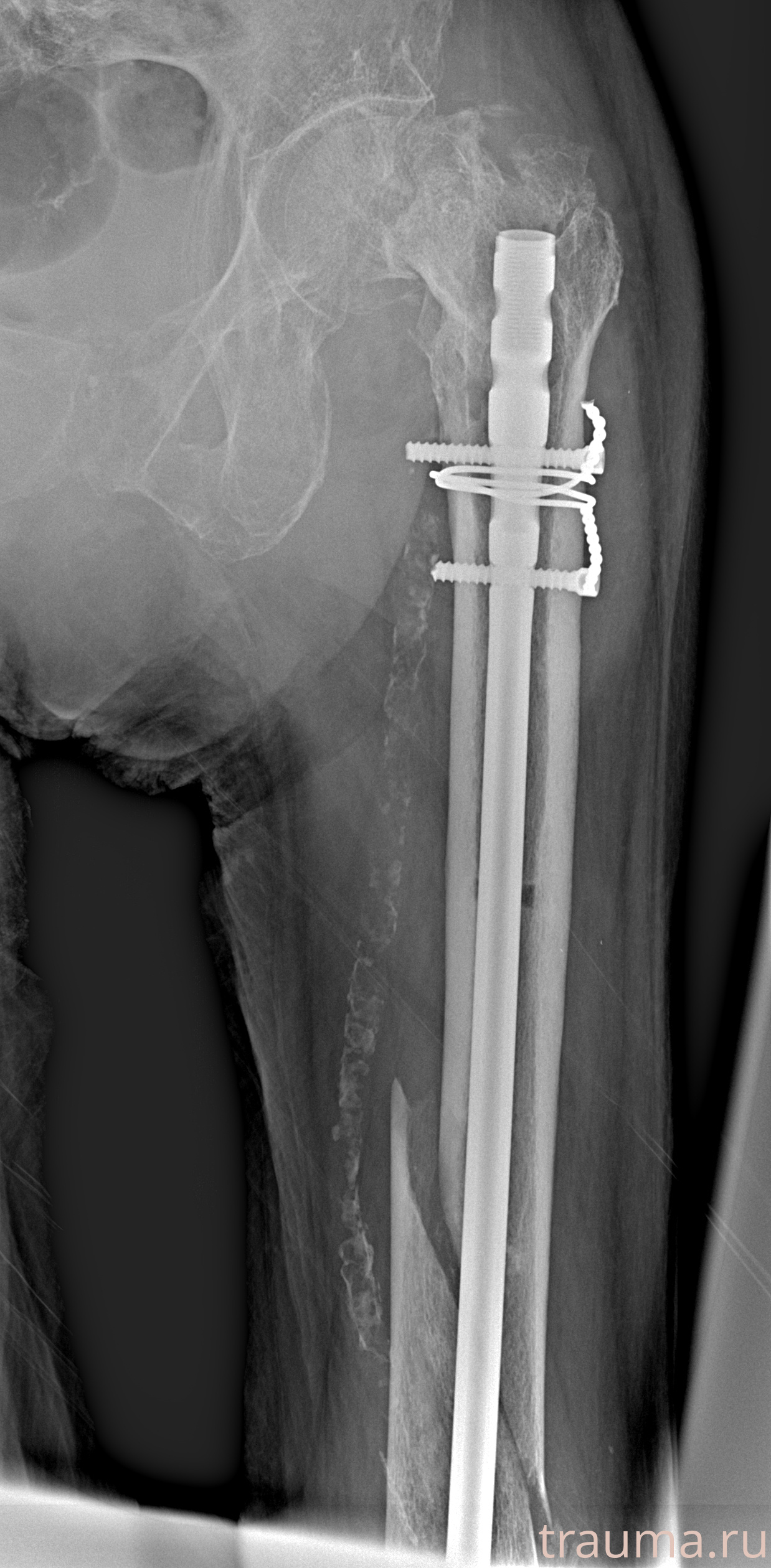 Рентген на дому: по вашему адресу приезжает врач-рентгенолог, травматолог-ортопед с мобильным рентгеновским аппаратом, проводит диагностику травмы или заболевания, делает необходимые рентгенограммы, дает рекомендации по дальнейшему лечению. Получить качественные снимки в домашних условиях возможно благодаря уникальной методике, разработанной МосРентген Центром для института  Склифосовского