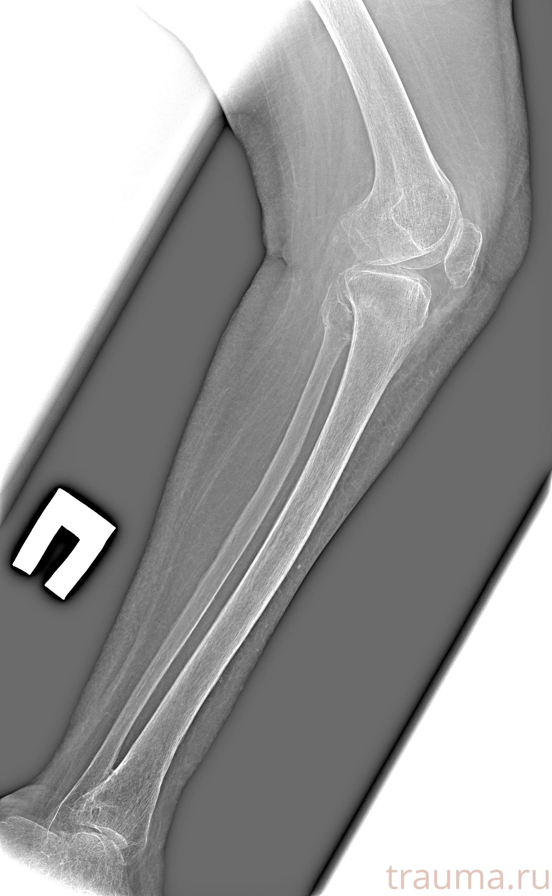 Рентген на дому: по вашему адресу приезжает врач-рентгенолог, травматолог-ортопед с мобильным рентгеновским аппаратом, проводит диагностику травмы или заболевания, делает необходимые рентгенограммы, дает рекомендации по дальнейшему лечению. Получить качественные снимки в домашних условиях возможно благодаря уникальной методике, разработанной МосРентген Центром для института  Склифосовского