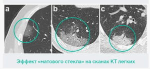 “Матовое стекло” - от наблюдения к действию. Современный арсенал диагностики периферических очаговых образований в легких по типу “матового стекла”
