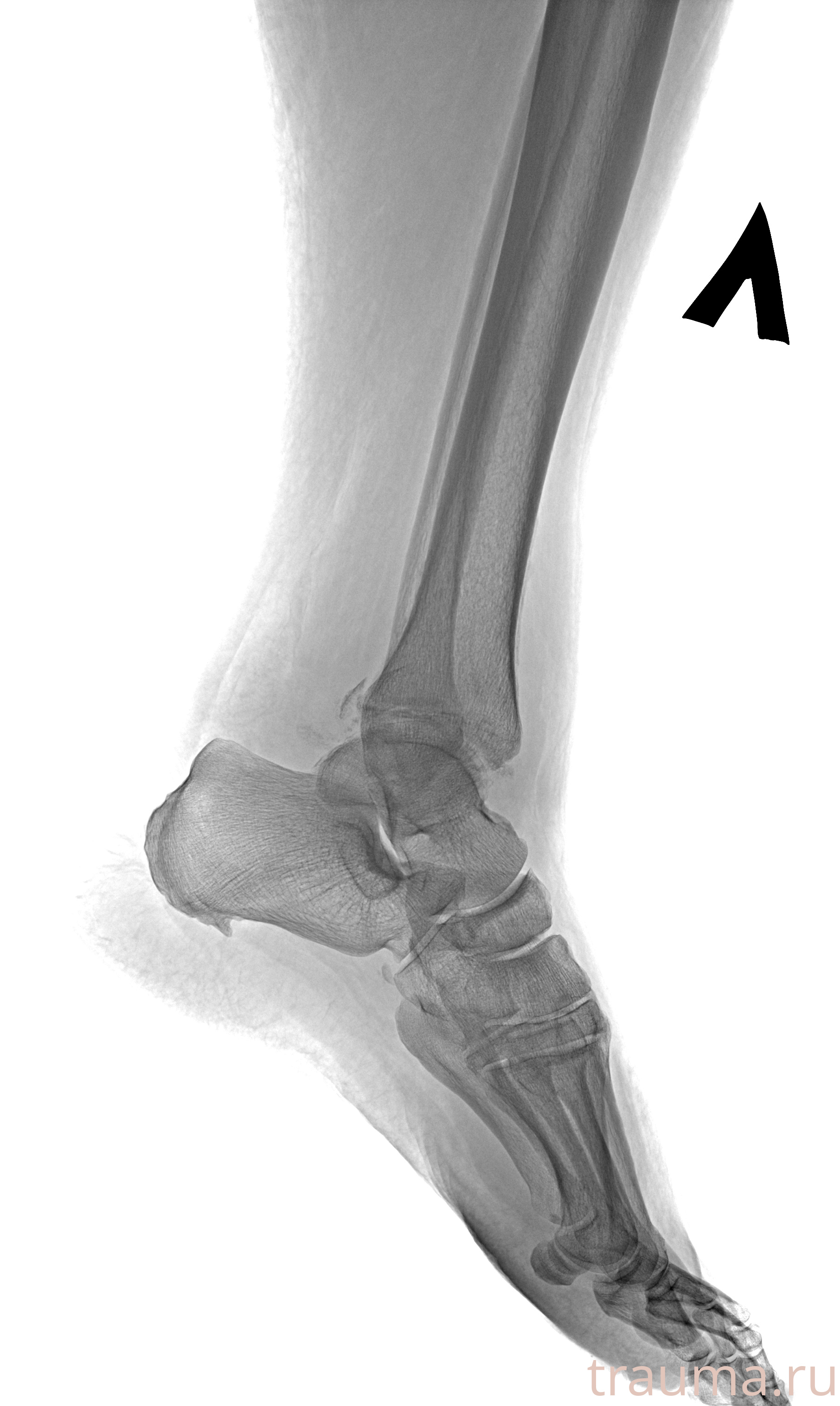 Рентген на дому: по вашему адресу приезжает врач-рентгенолог, травматолог-ортопед с мобильным рентгеновским аппаратом, проводит диагностику травмы или заболевания, делает необходимые рентгенограммы, дает рекомендации по дальнейшему лечению. Получить качественные снимки в домашних условиях возможно благодаря уникальной методике, разработанной МосРентген Центром для института  Склифосовского