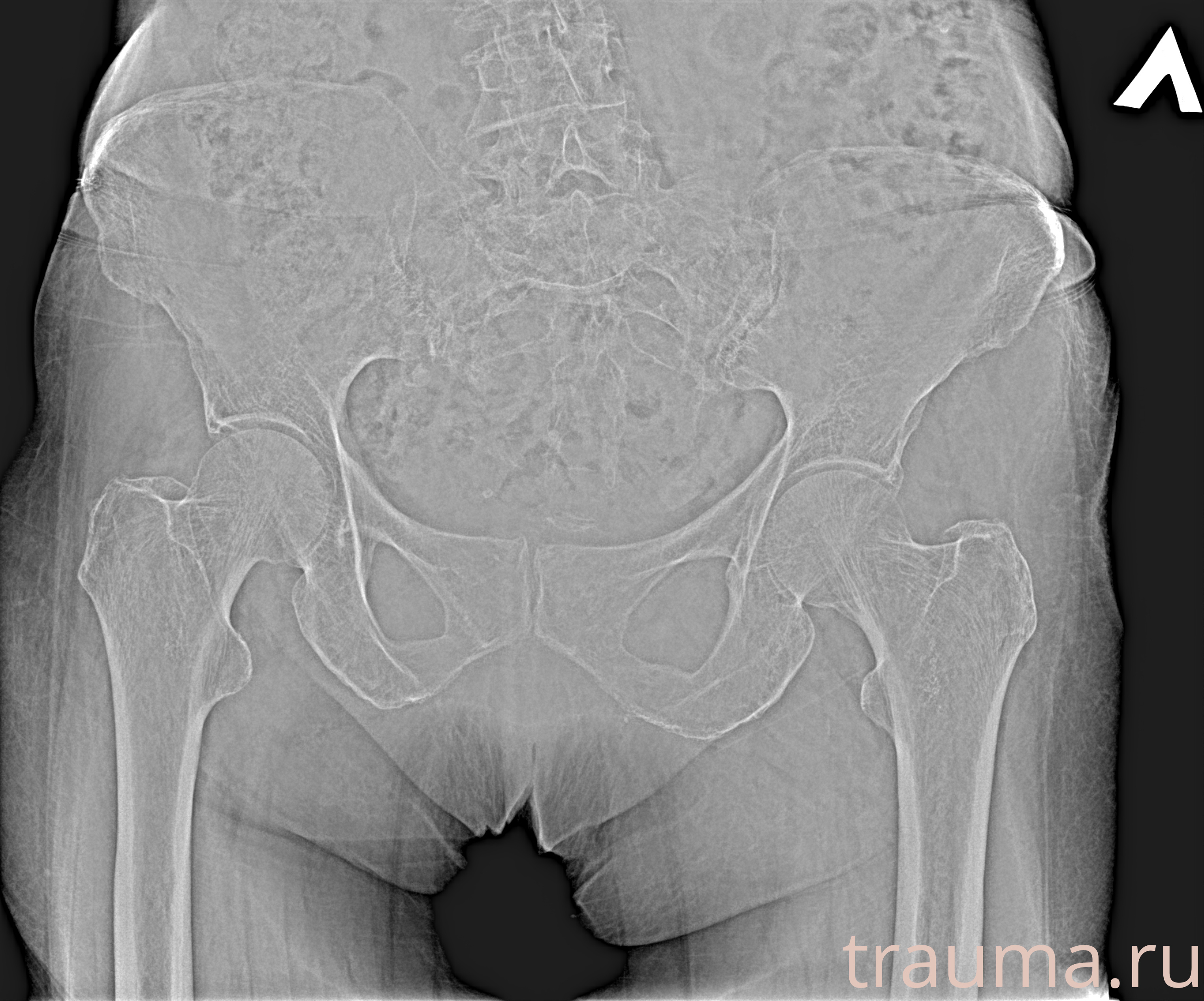 Рентген на дому: по вашему адресу приезжает врач-рентгенолог, травматолог-ортопед с мобильным рентгеновским аппаратом, проводит диагностику травмы или заболевания, делает необходимые рентгенограммы, дает рекомендации по дальнейшему лечению. Получить качественные снимки в домашних условиях возможно благодаря уникальной методике, разработанной МосРентген Центром для института  Склифосовского