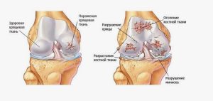 Повреждения хряща коленного сустава