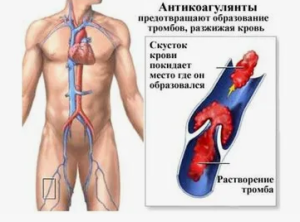 Венозные тромбоэмболические осложнения у пациентов с травмами Венозные тромбоэмболические осложнения у пациентов с травмами