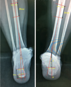 Хирургическое лечение пациентов с последствиями переломов пяточной кости 4 типа по Zwipp – Rammelt с применением индивидуально изготовленных резекционных шаблонов 