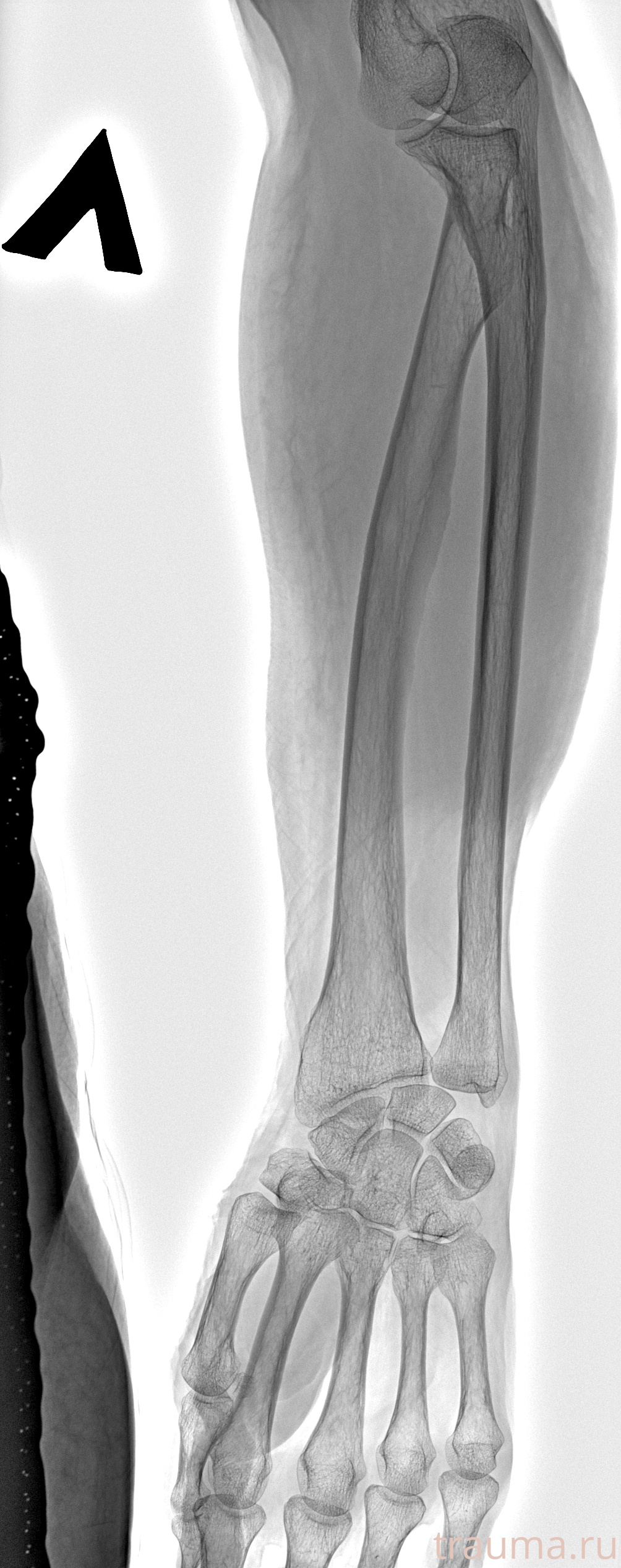 Рентген на дому: по вашему адресу приезжает врач-рентгенолог, травматолог-ортопед с мобильным рентгеновским аппаратом, проводит диагностику травмы или заболевания, делает необходимые рентгенограммы, дает рекомендации по дальнейшему лечению. Получить качественные снимки в домашних условиях возможно благодаря уникальной методике, разработанной МосРентген Центром для института  Склифосовского