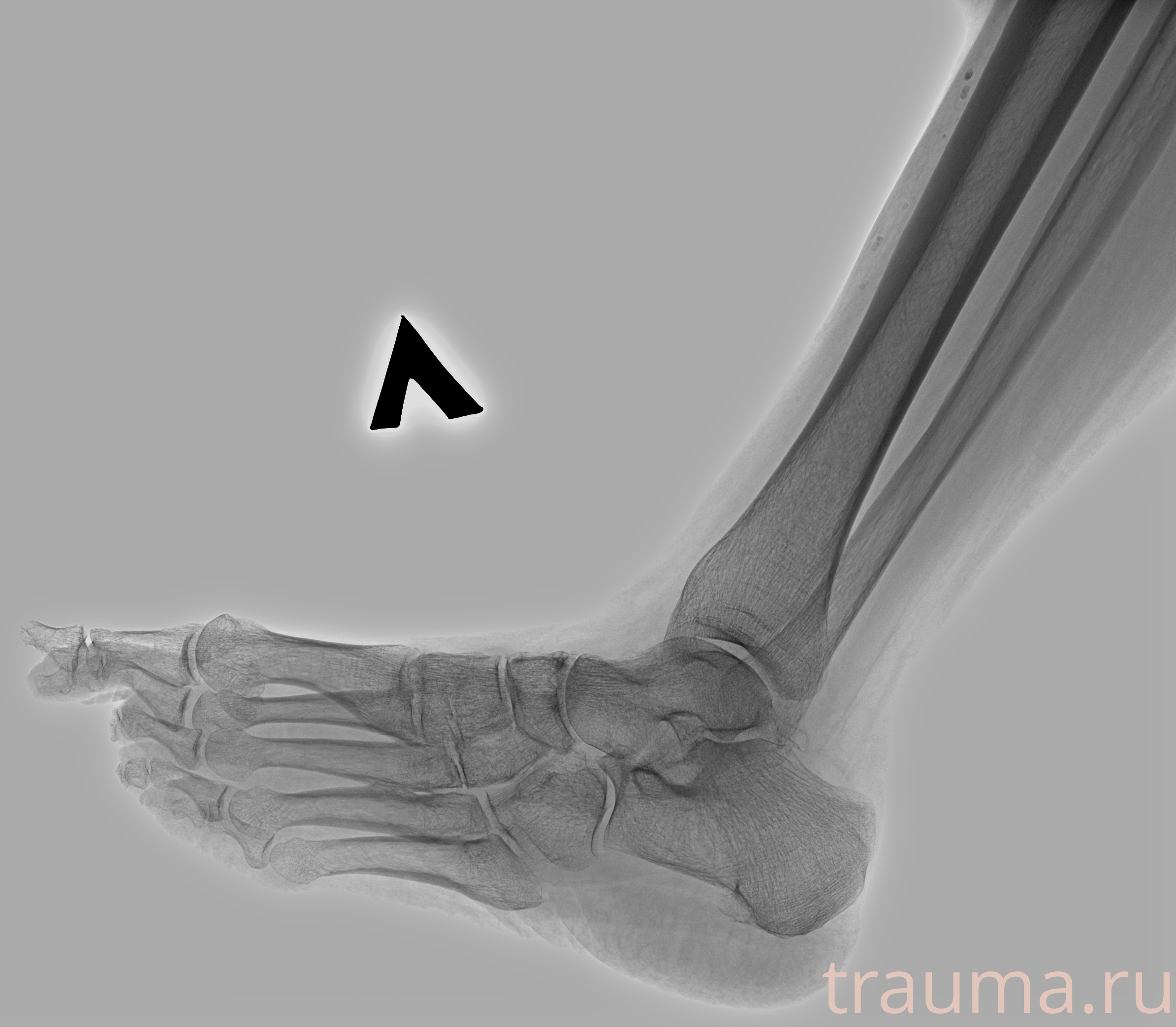 Рентген на дому: по вашему адресу приезжает врач-рентгенолог, травматолог-ортопед с мобильным рентгеновским аппаратом, проводит диагностику травмы или заболевания, делает необходимые рентгенограммы, дает рекомендации по дальнейшему лечению. Получить качественные снимки в домашних условиях возможно благодаря уникальной методике, разработанной МосРентген Центром для института  Склифосовского