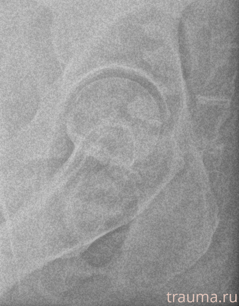 Рентген на дому: по вашему адресу приезжает врач-рентгенолог, травматолог-ортопед с мобильным рентгеновским аппаратом, проводит диагностику травмы или заболевания, делает необходимые рентгенограммы, дает рекомендации по дальнейшему лечению. Получить качественные снимки в домашних условиях возможно благодаря уникальной методике, разработанной МосРентген Центром для института  Склифосовского