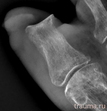 Рентген на дому: по вашему адресу приезжает врач-рентгенолог, травматолог-ортопед с мобильным рентгеновским аппаратом, проводит диагностику травмы или заболевания, делает необходимые рентгенограммы, дает рекомендации по дальнейшему лечению. Получить качественные снимки в домашних условиях возможно благодаря уникальной методике, разработанной МосРентген Центром для института  Склифосовского