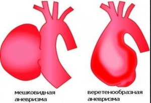 Курс медицинской рентгенологии.Рентгенологическое исследование органов кровообращения(сердца и больших сосудов).Часть 2. Глава 8.6