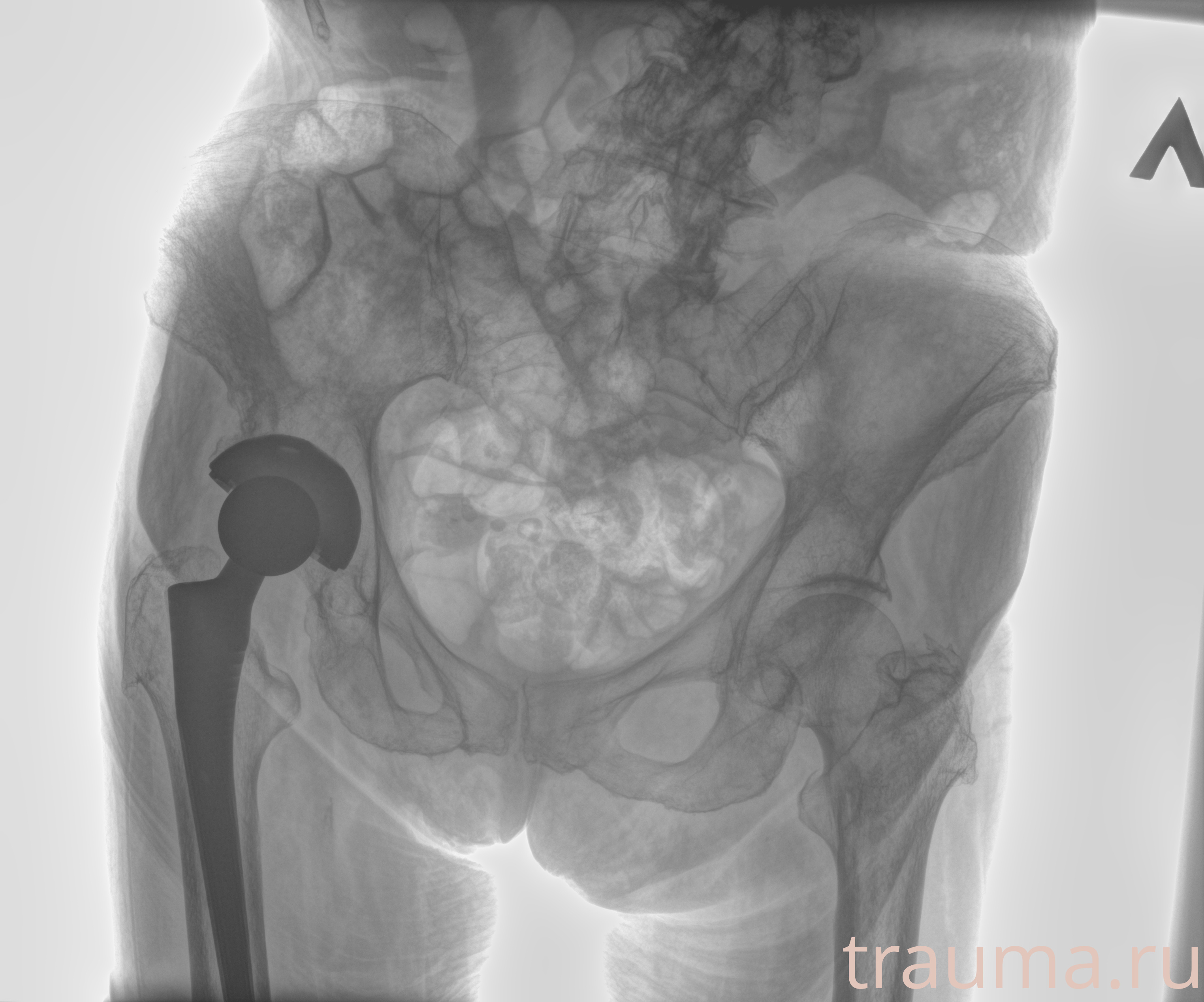 Рентген на дому: по вашему адресу приезжает врач-рентгенолог, травматолог-ортопед с мобильным рентгеновским аппаратом, проводит диагностику травмы или заболевания, делает необходимые рентгенограммы, дает рекомендации по дальнейшему лечению. Получить качественные снимки в домашних условиях возможно благодаря уникальной методике, разработанной МосРентген Центром для института  Склифосовского