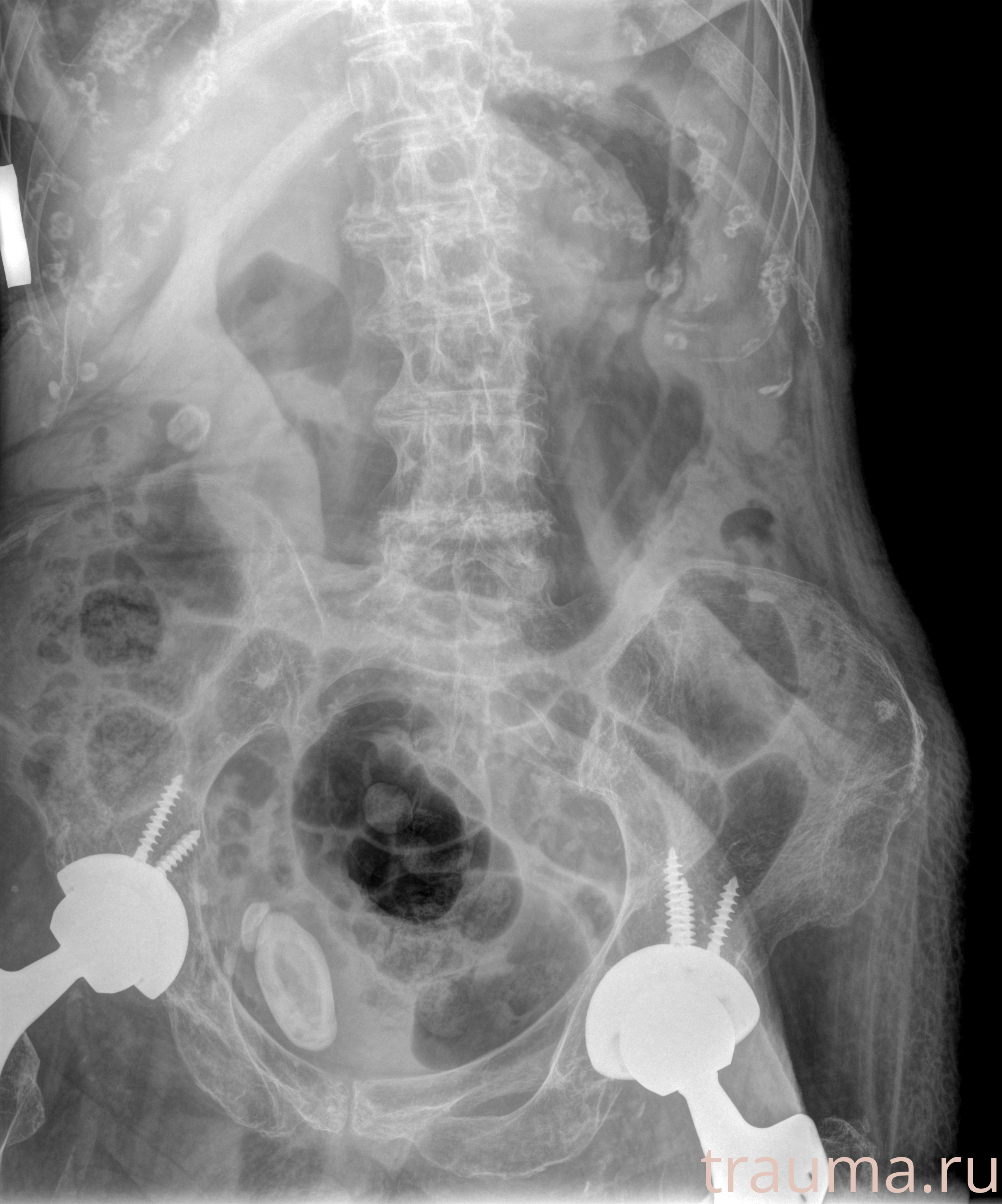 Рентген на дому: по вашему адресу приезжает врач-рентгенолог, травматолог-ортопед с мобильным рентгеновским аппаратом, проводит диагностику травмы или заболевания, делает необходимые рентгенограммы, дает рекомендации по дальнейшему лечению. Получить качественные снимки в домашних условиях возможно благодаря уникальной методике, разработанной МосРентген Центром для института  Склифосовского