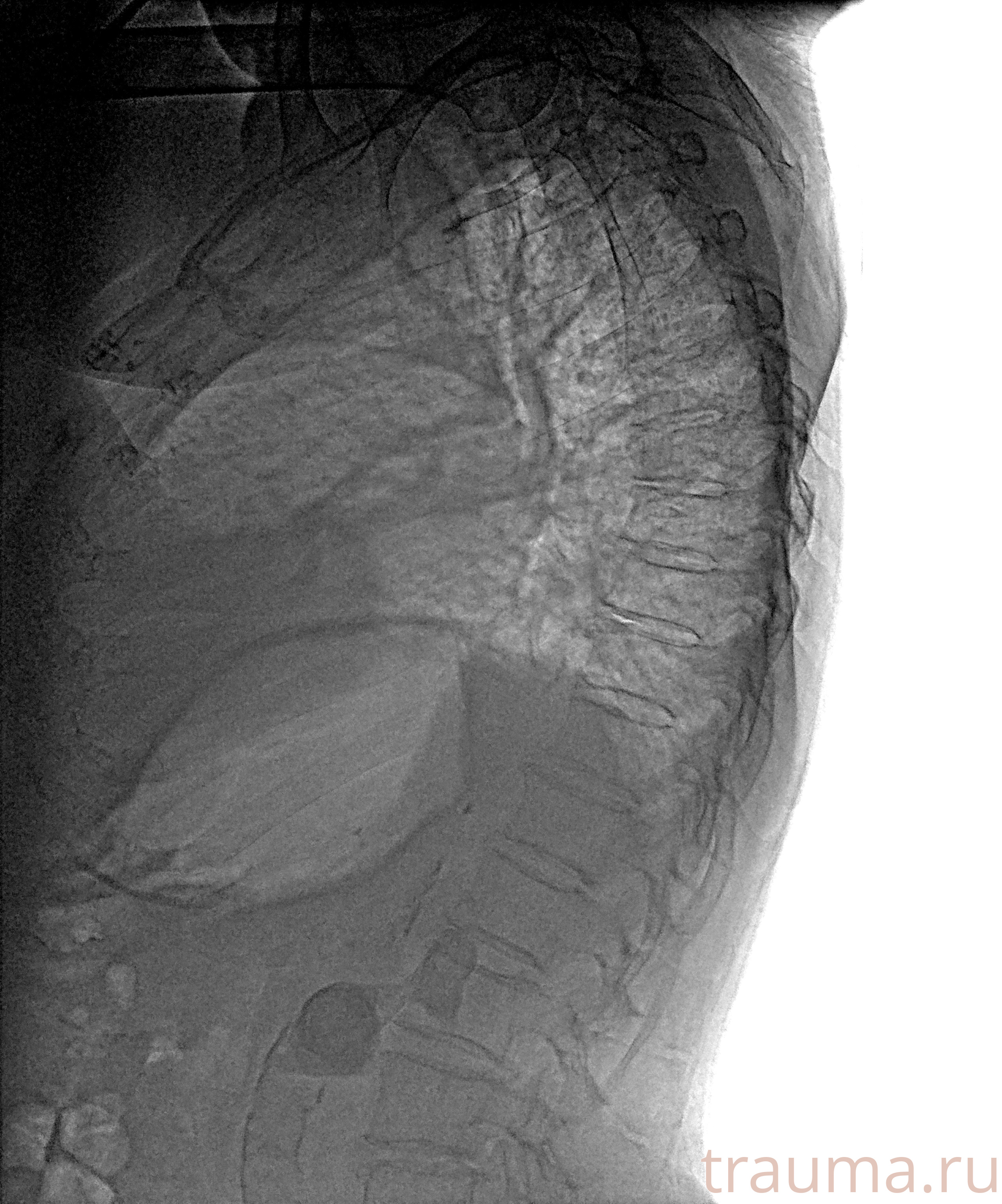 Рентген на дому: по вашему адресу приезжает врач-рентгенолог, травматолог-ортопед с мобильным рентгеновским аппаратом, проводит диагностику травмы или заболевания, делает необходимые рентгенограммы, дает рекомендации по дальнейшему лечению. Получить качественные снимки в домашних условиях возможно благодаря уникальной методике, разработанной МосРентген Центром для института  Склифосовского