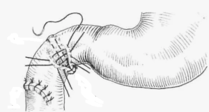 Хирургическая тактика при огнестрельных ранениях живота с повреждением тонкой кишки