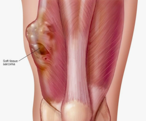 Пациентка с саркомой Юинга мягких тканей промежности и малого таза