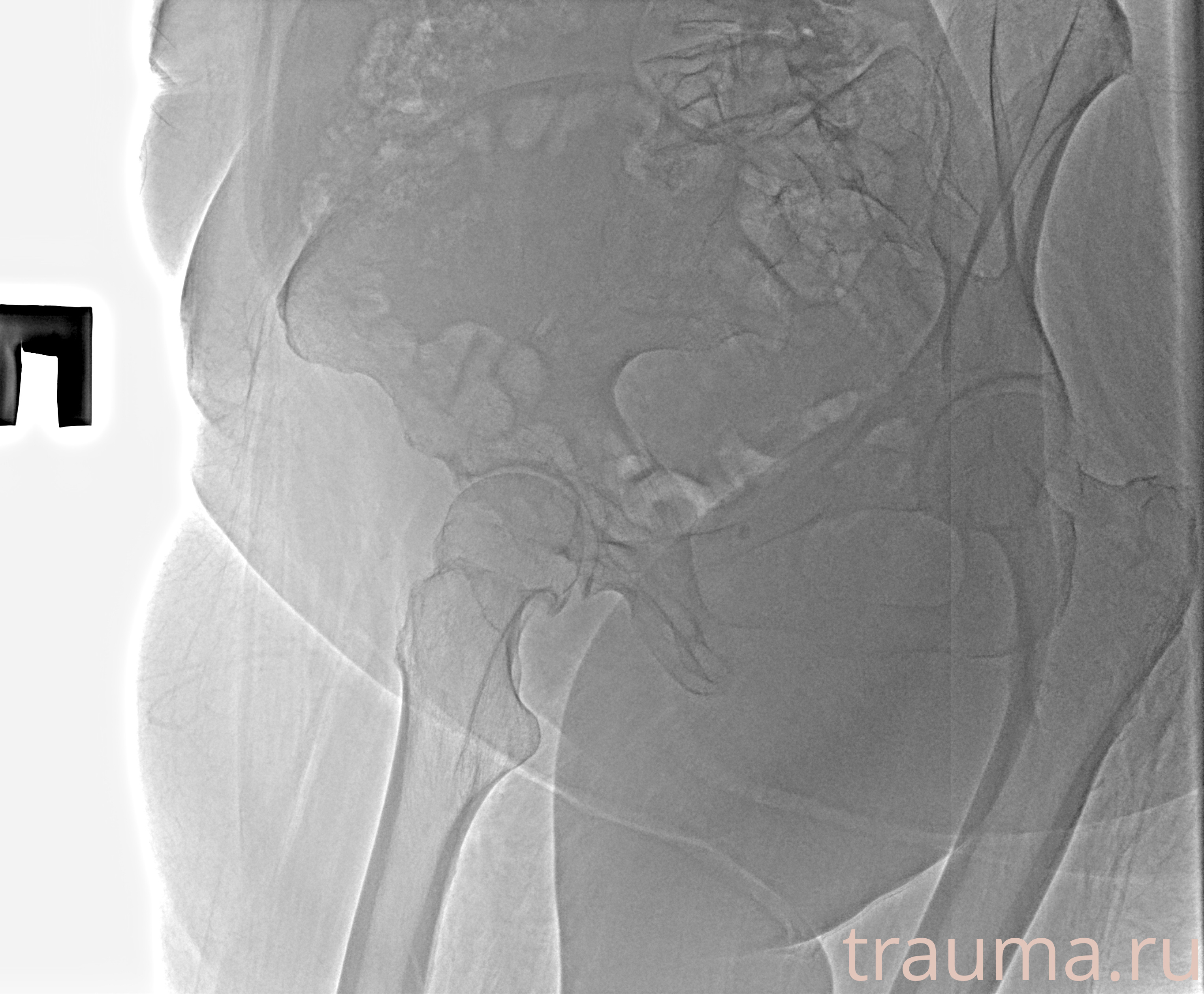 Рентген на дому: по вашему адресу приезжает врач-рентгенолог, травматолог-ортопед с мобильным рентгеновским аппаратом, проводит диагностику травмы или заболевания, делает необходимые рентгенограммы, дает рекомендации по дальнейшему лечению. Получить качественные снимки в домашних условиях возможно благодаря уникальной методике, разработанной МосРентген Центром для института  Склифосовского