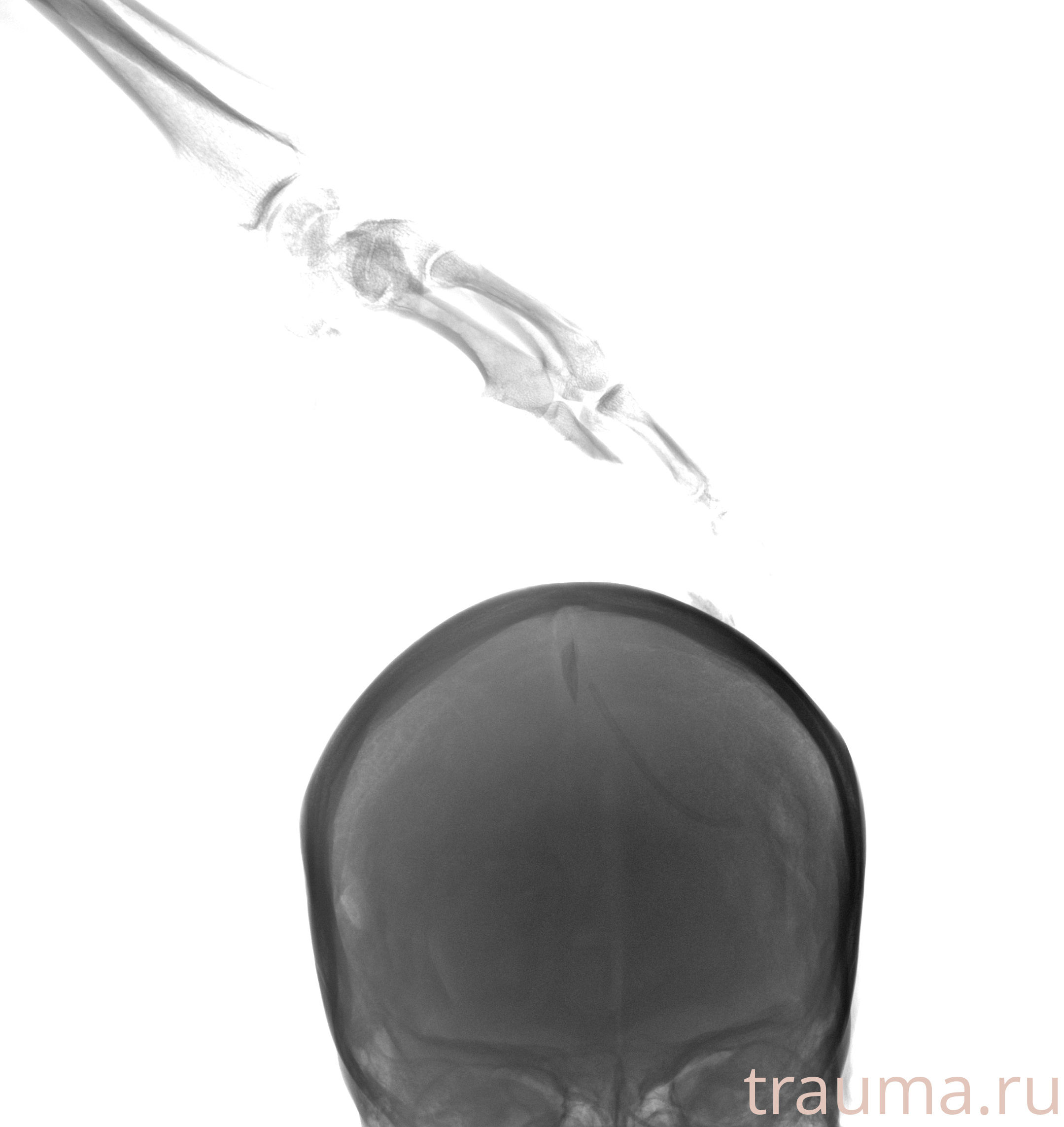 Рентген на дому: по вашему адресу приезжает врач-рентгенолог, травматолог-ортопед с мобильным рентгеновским аппаратом, проводит диагностику травмы или заболевания, делает необходимые рентгенограммы, дает рекомендации по дальнейшему лечению. Получить качественные снимки в домашних условиях возможно благодаря уникальной методике, разработанной МосРентген Центром для института  Склифосовского