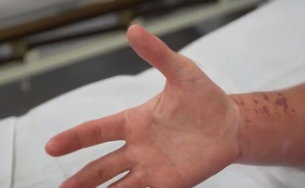  Ожог от медузы