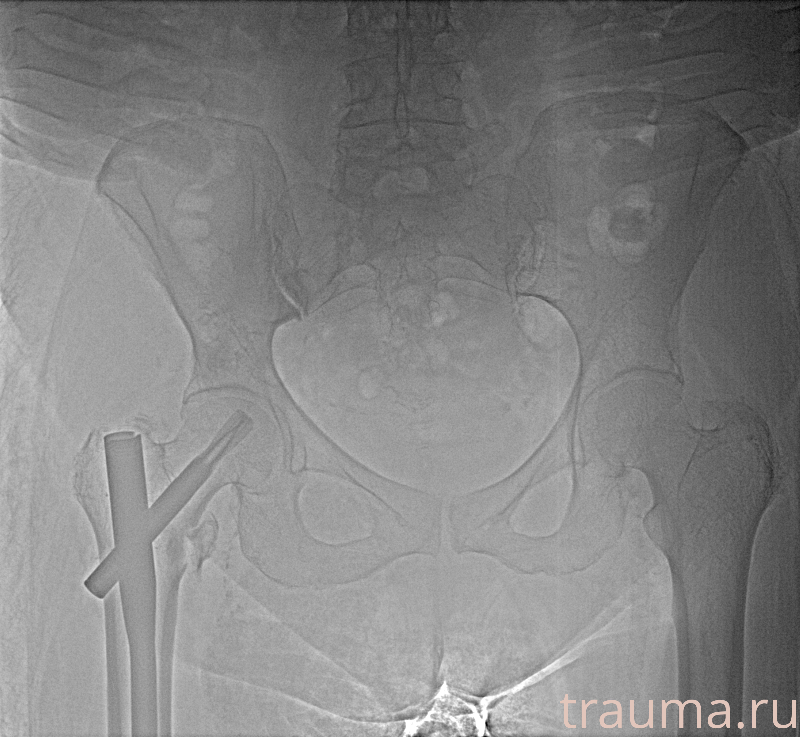 Рентген на дому: по вашему адресу приезжает врач-рентгенолог, травматолог-ортопед с мобильным рентгеновским аппаратом, проводит диагностику травмы или заболевания, делает необходимые рентгенограммы, дает рекомендации по дальнейшему лечению. Получить качественные снимки в домашних условиях возможно благодаря уникальной методике, разработанной МосРентген Центром для института  Склифосовского