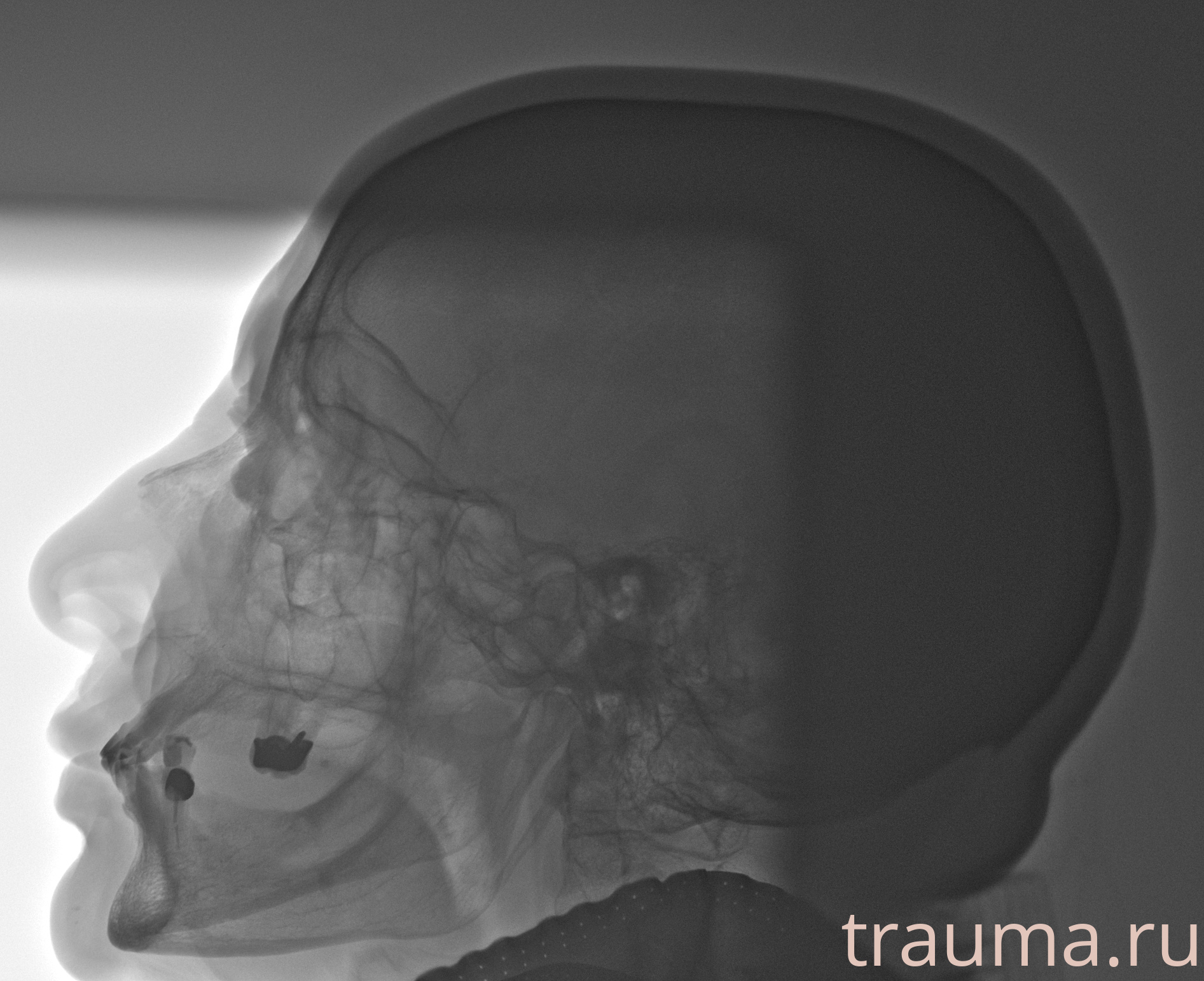 Рентген на дому: по вашему адресу приезжает врач-рентгенолог, травматолог-ортопед с мобильным рентгеновским аппаратом, проводит диагностику травмы или заболевания, делает необходимые рентгенограммы, дает рекомендации по дальнейшему лечению. Получить качественные снимки в домашних условиях возможно благодаря уникальной методике, разработанной МосРентген Центром для института  Склифосовского