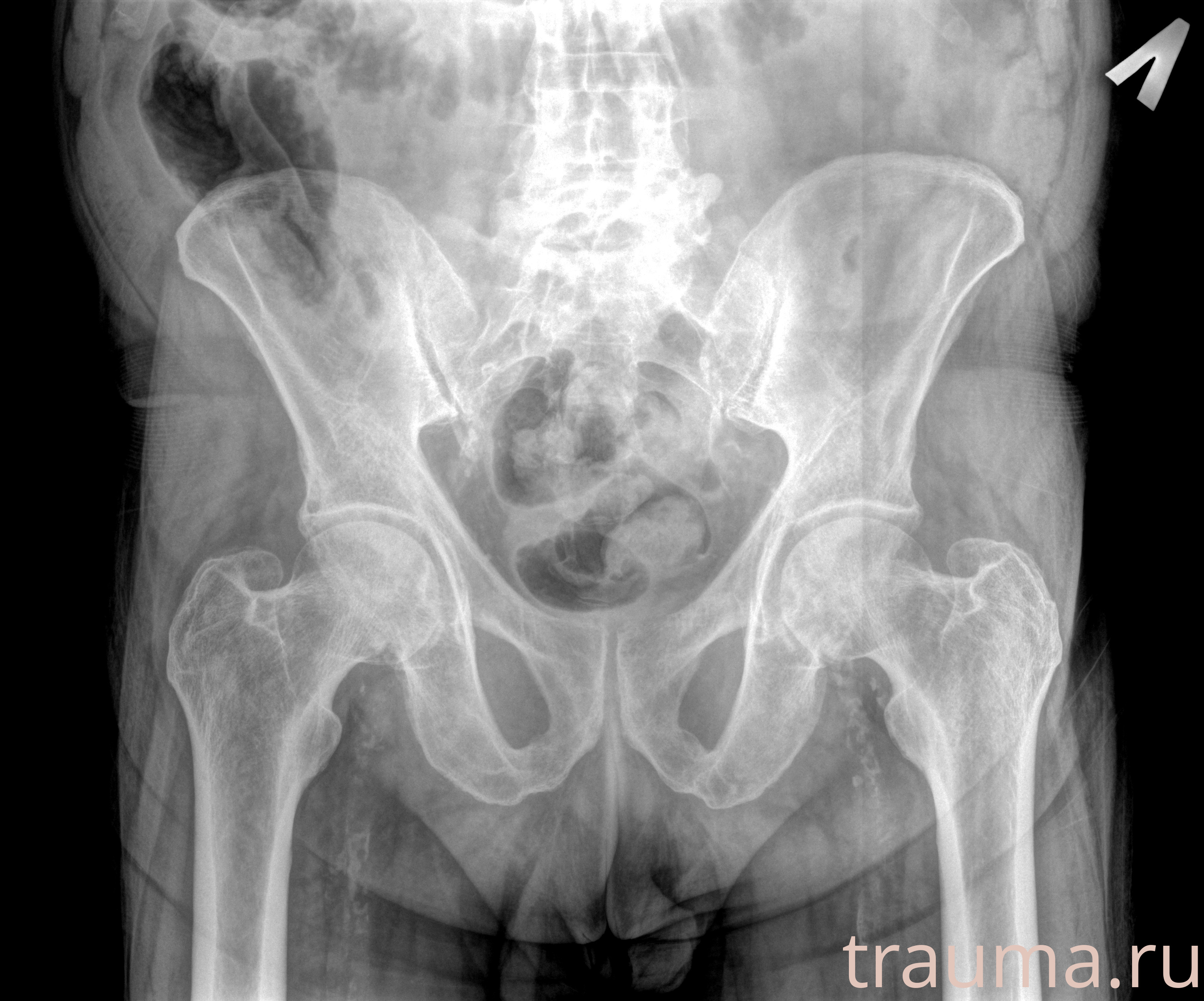 Рентген на дому: по вашему адресу приезжает врач-рентгенолог, травматолог-ортопед с мобильным рентгеновским аппаратом, проводит диагностику травмы или заболевания, делает необходимые рентгенограммы, дает рекомендации по дальнейшему лечению. Получить качественные снимки в домашних условиях возможно благодаря уникальной методике, разработанной МосРентген Центром для института  Склифосовского