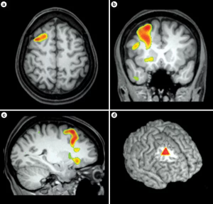 Стандарты выполнения магнитно-резонансной томографии головного мозга для диагностики эпилепсии 