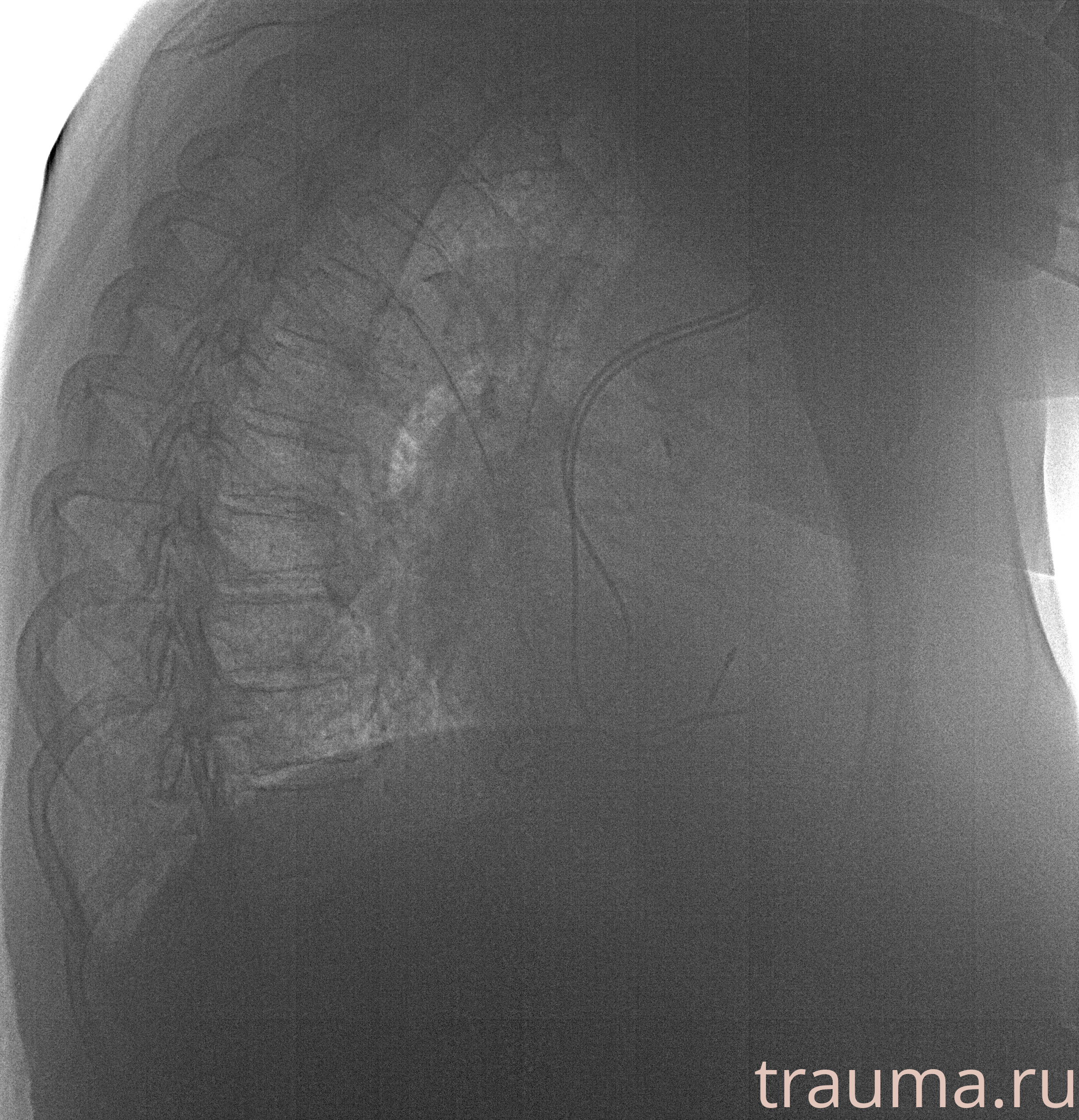 Рентген на дому: по вашему адресу приезжает врач-рентгенолог, травматолог-ортопед с мобильным рентгеновским аппаратом, проводит диагностику травмы или заболевания, делает необходимые рентгенограммы, дает рекомендации по дальнейшему лечению. Получить качественные снимки в домашних условиях возможно благодаря уникальной методике, разработанной МосРентген Центром для института  Склифосовского