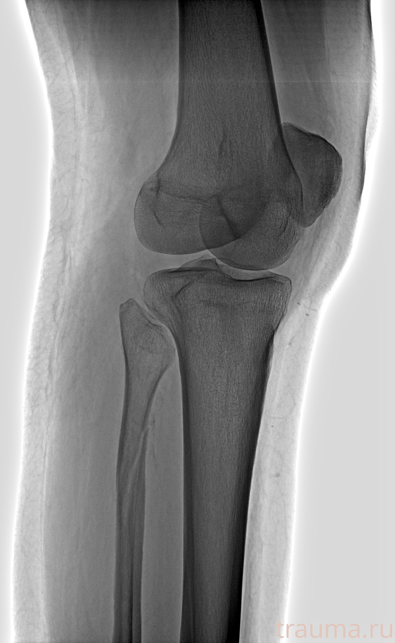 Рентген на дому: по вашему адресу приезжает врач-рентгенолог, травматолог-ортопед с мобильным рентгеновским аппаратом, проводит диагностику травмы или заболевания, делает необходимые рентгенограммы, дает рекомендации по дальнейшему лечению. Получить качественные снимки в домашних условиях возможно благодаря уникальной методике, разработанной МосРентген Центром для института  Склифосовского