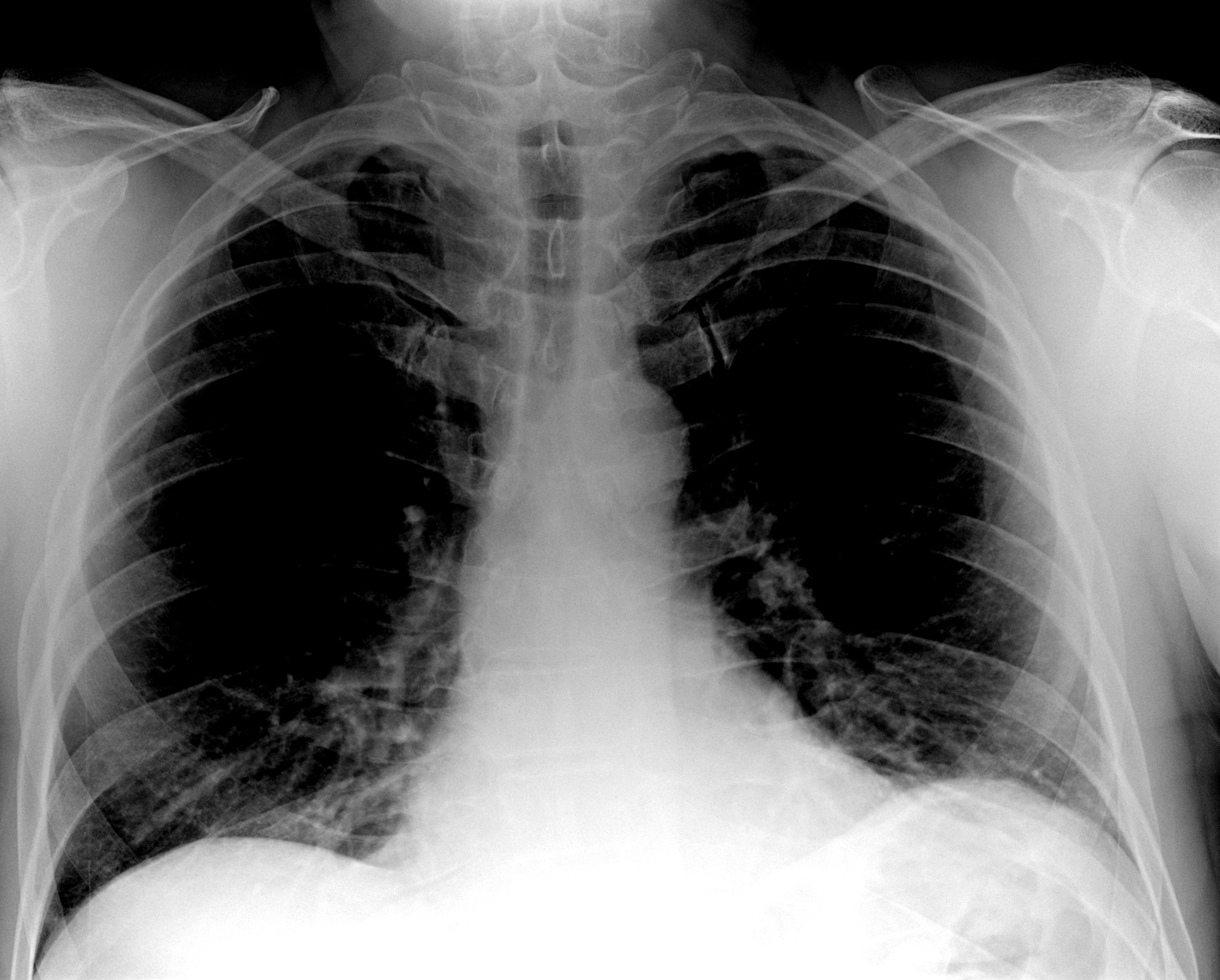 Пневмофиброз — нешуточное коварство. Как поддержать заболевшие лёгкие?